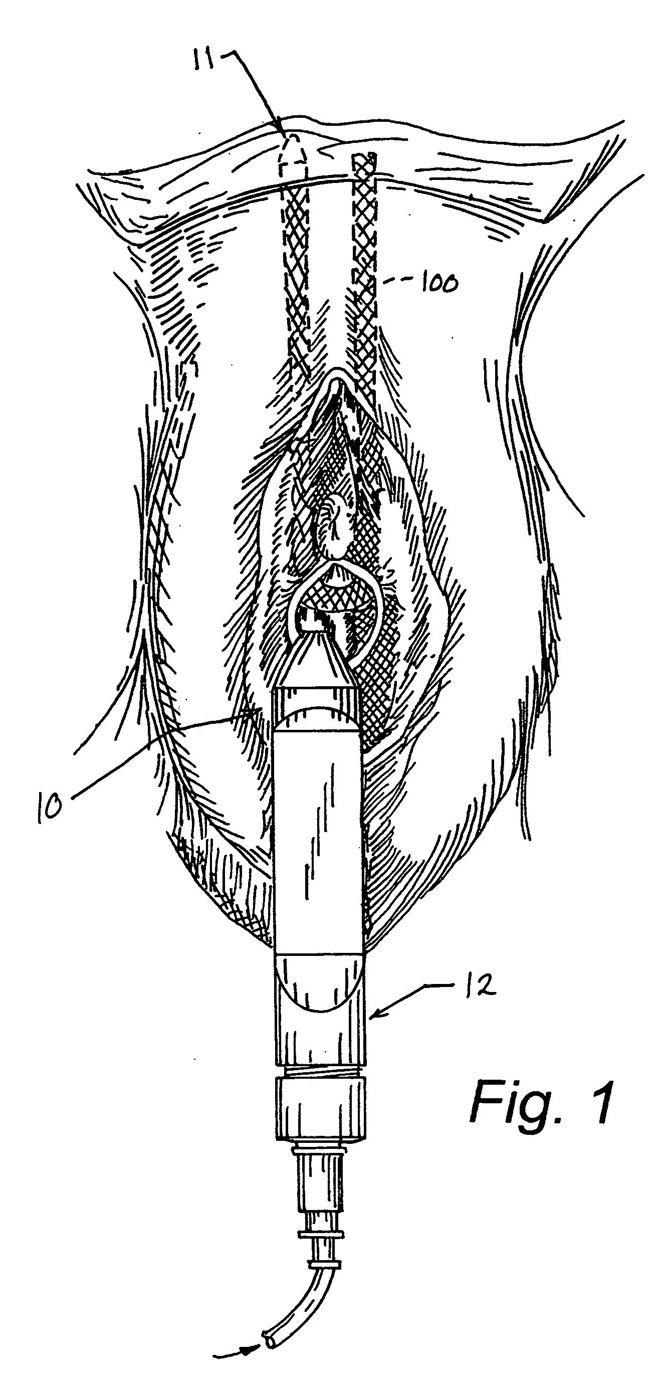 Urethral sling introducer and method of use