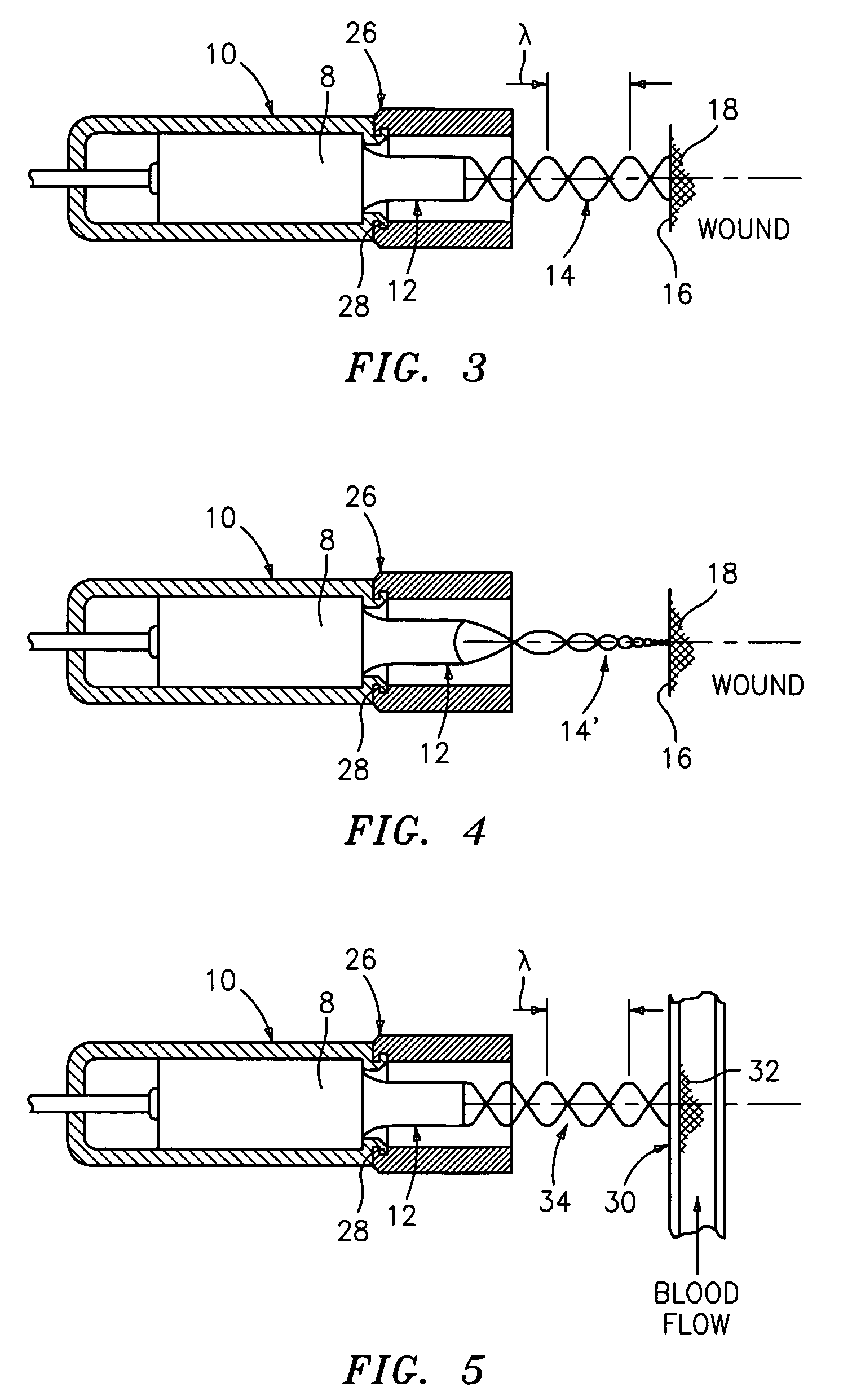 Ultrasound wound treatment method and device using standing waves