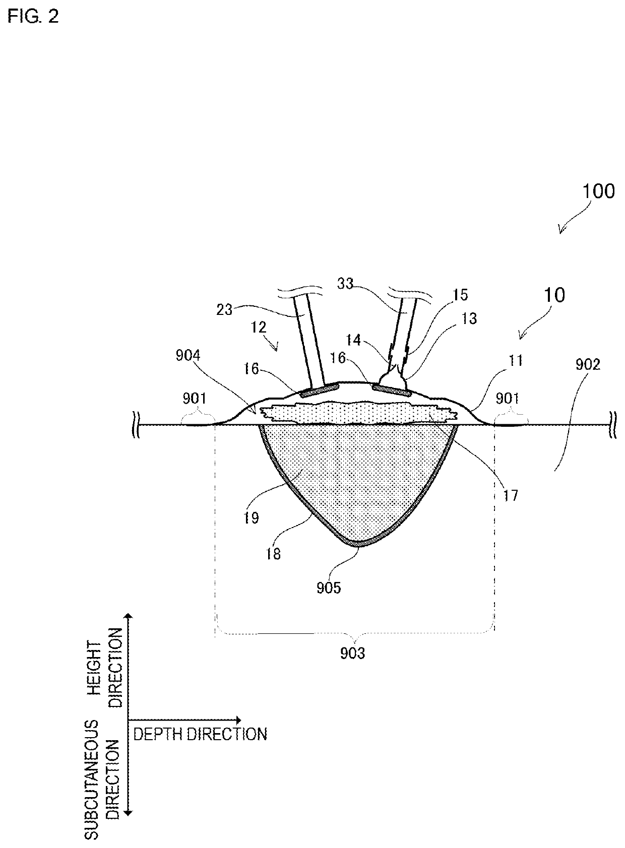 Negative-pressure wound therapy apparatus