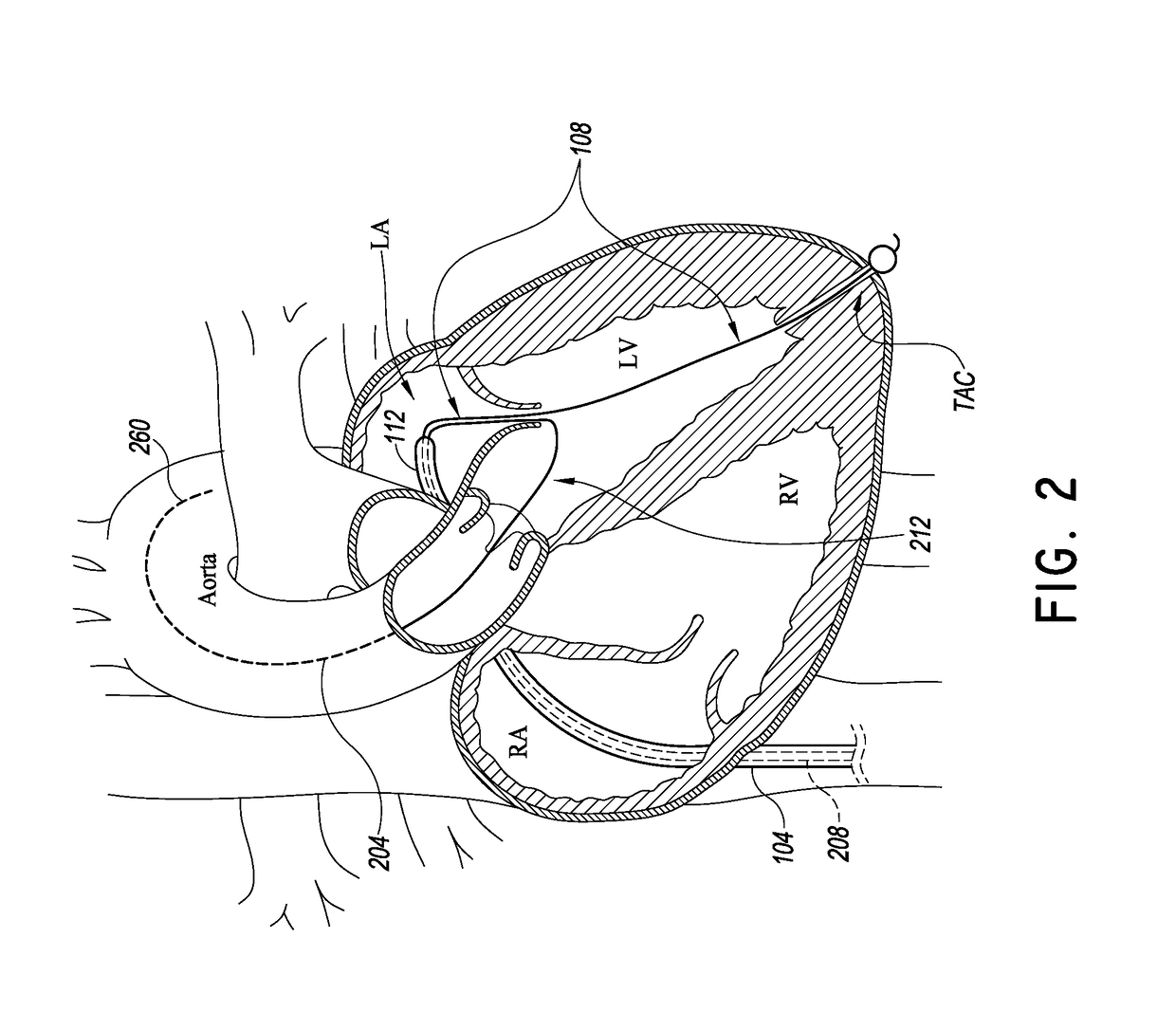 Catheter based apical approach heart prostheses delivery system