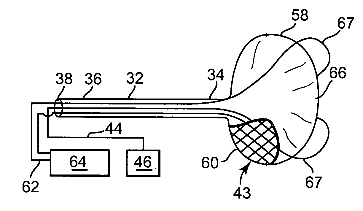 Method and devices for treating atrial fibrillation by mass ablation