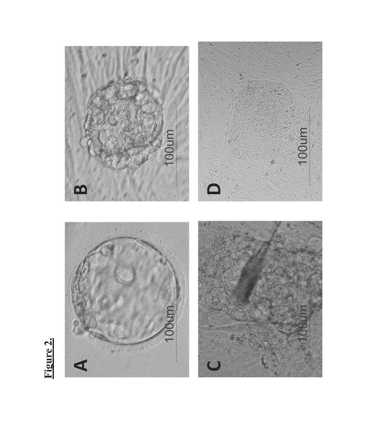 Production of parthenogenetic stem cells and patient-specific human embryonic stem cells using somatic cell nuclear transfer