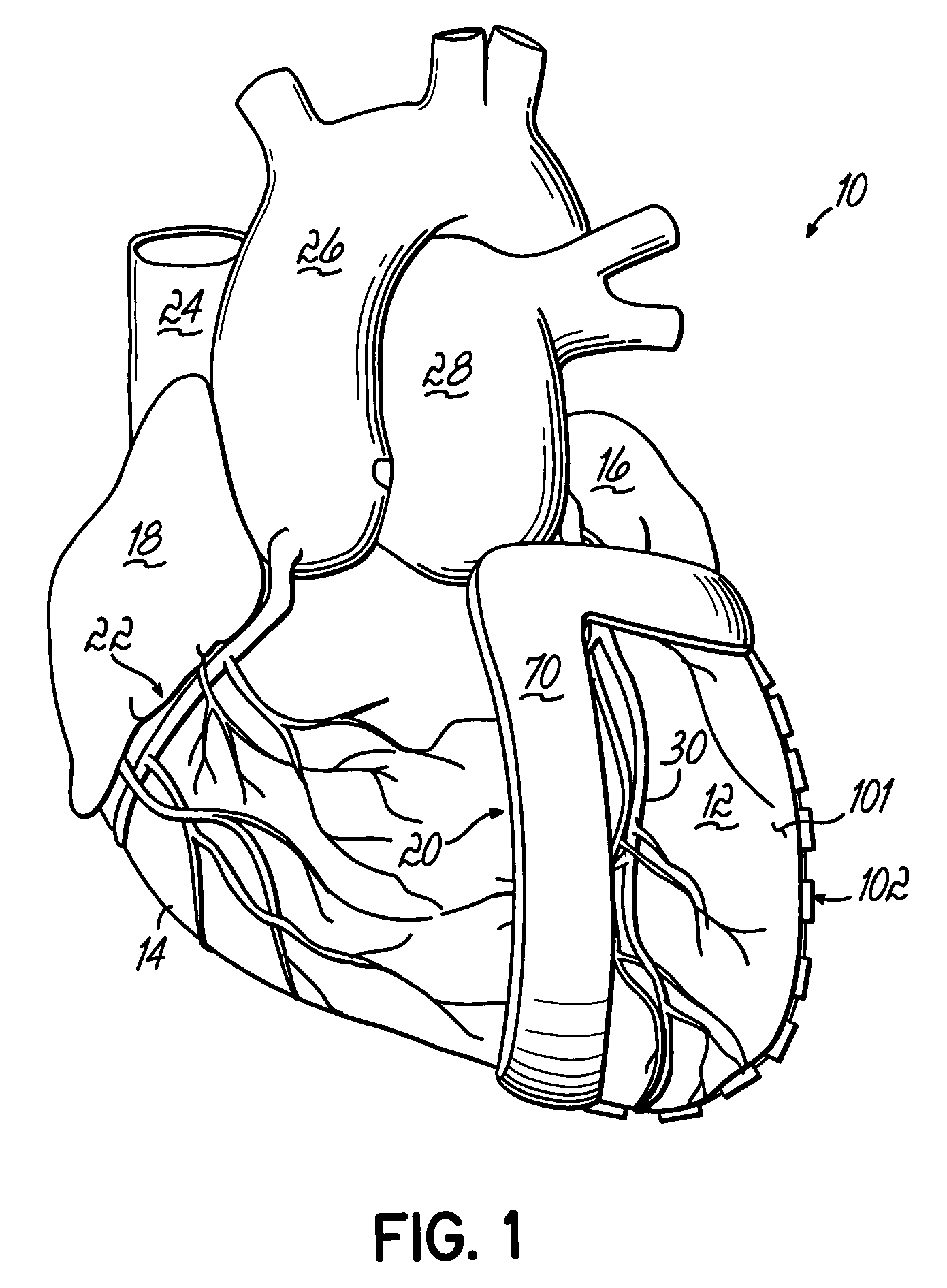 Heart wall actuation device for the natural heart