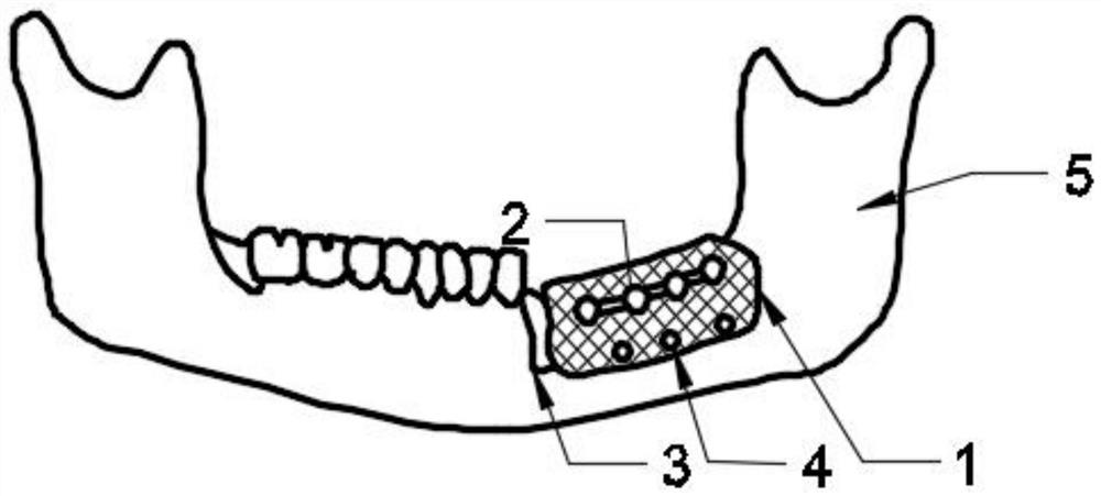 Oral implant