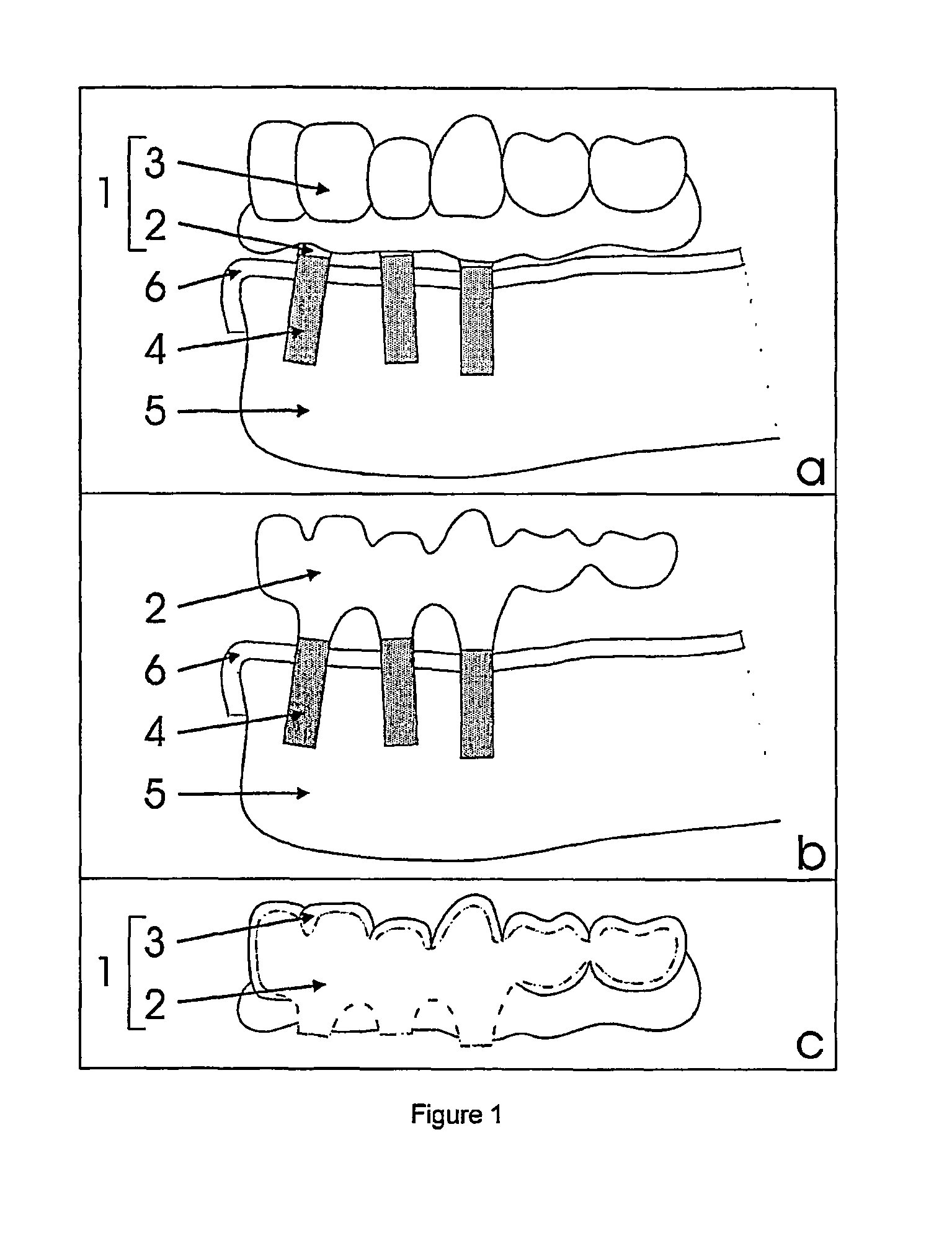 Procedure for design and production of implant-based frameworks for complex dental prostheses