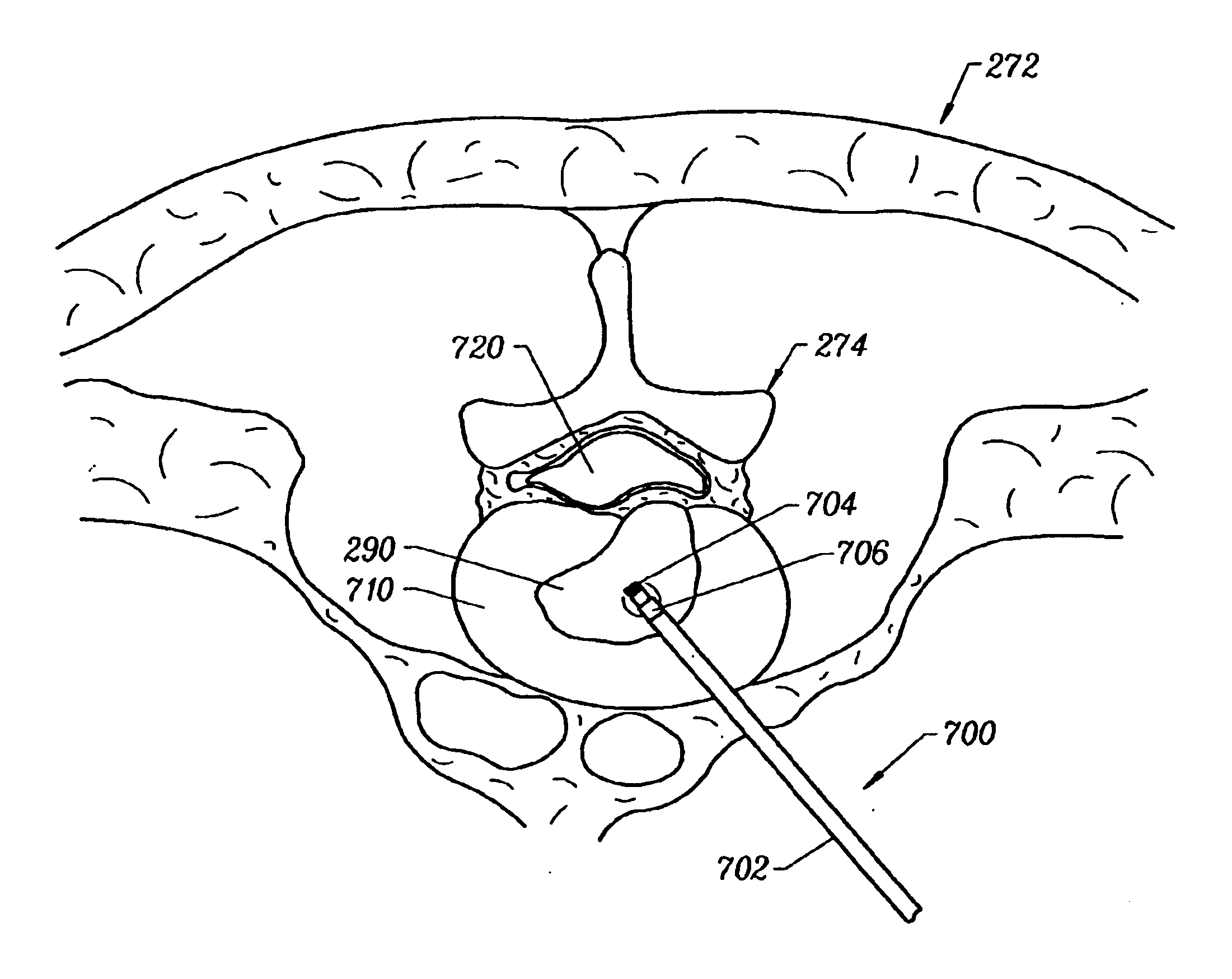 Methods for electrosurgical tissue contraction within the spine