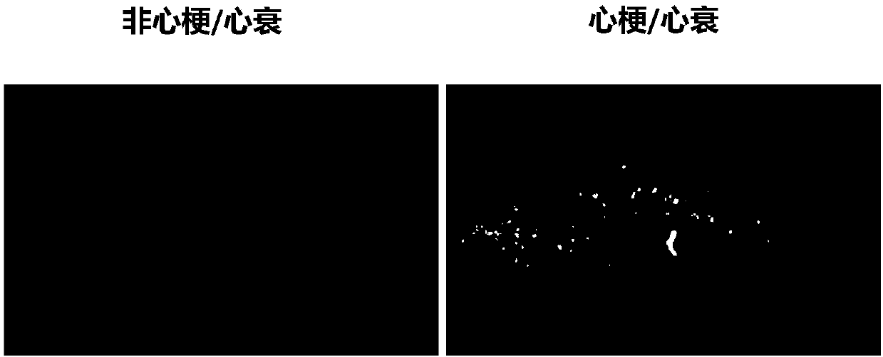 Method for judging myocardial infarction, heart failure and healing degrees on basis of zygomorphy and intensity of nail autofluorescence and application thereof