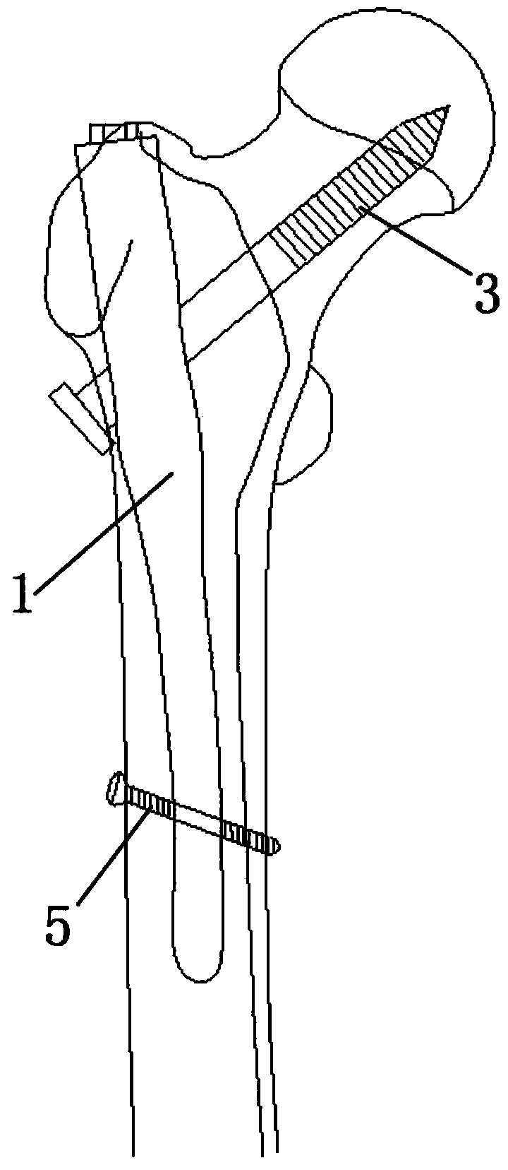 Modified proximal femoral nail