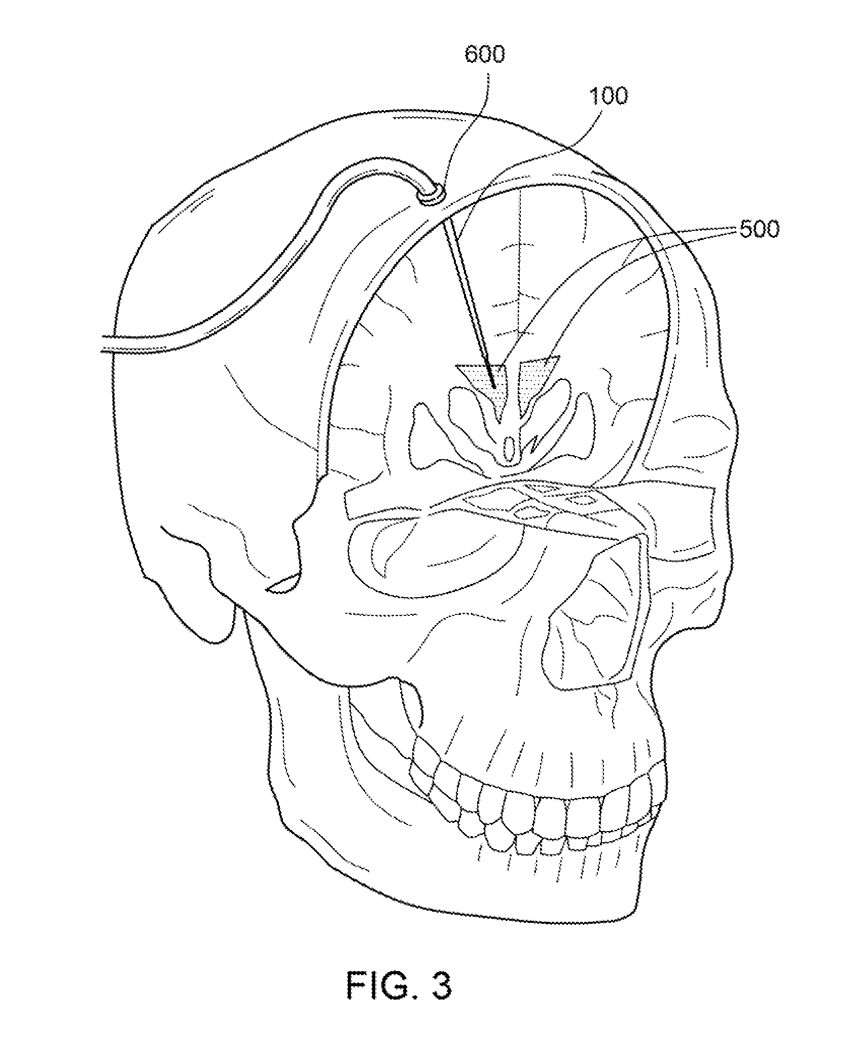 Cerebrospinal Fluid Cooling Device