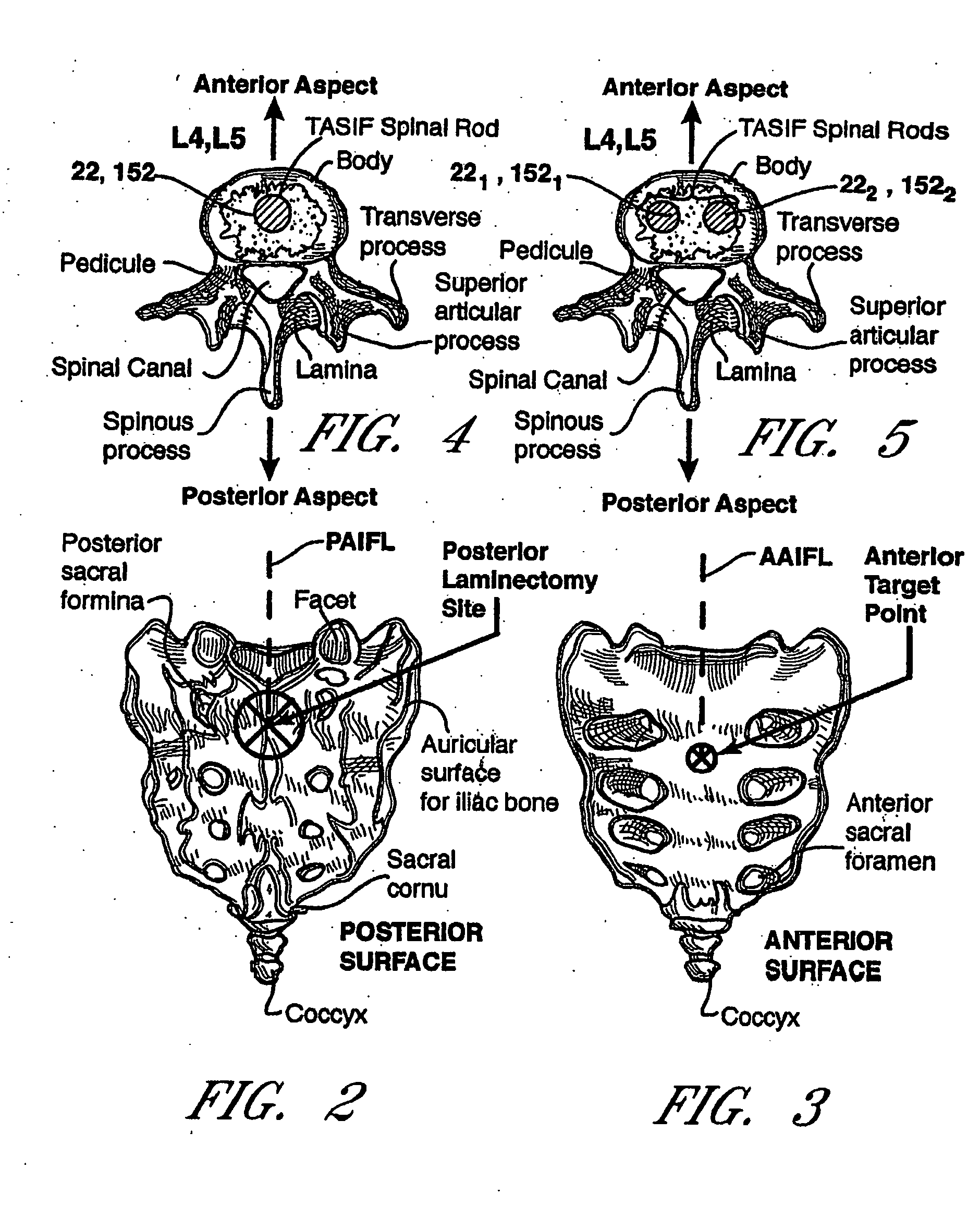 Method and apparatus for spinal distraction and fusion