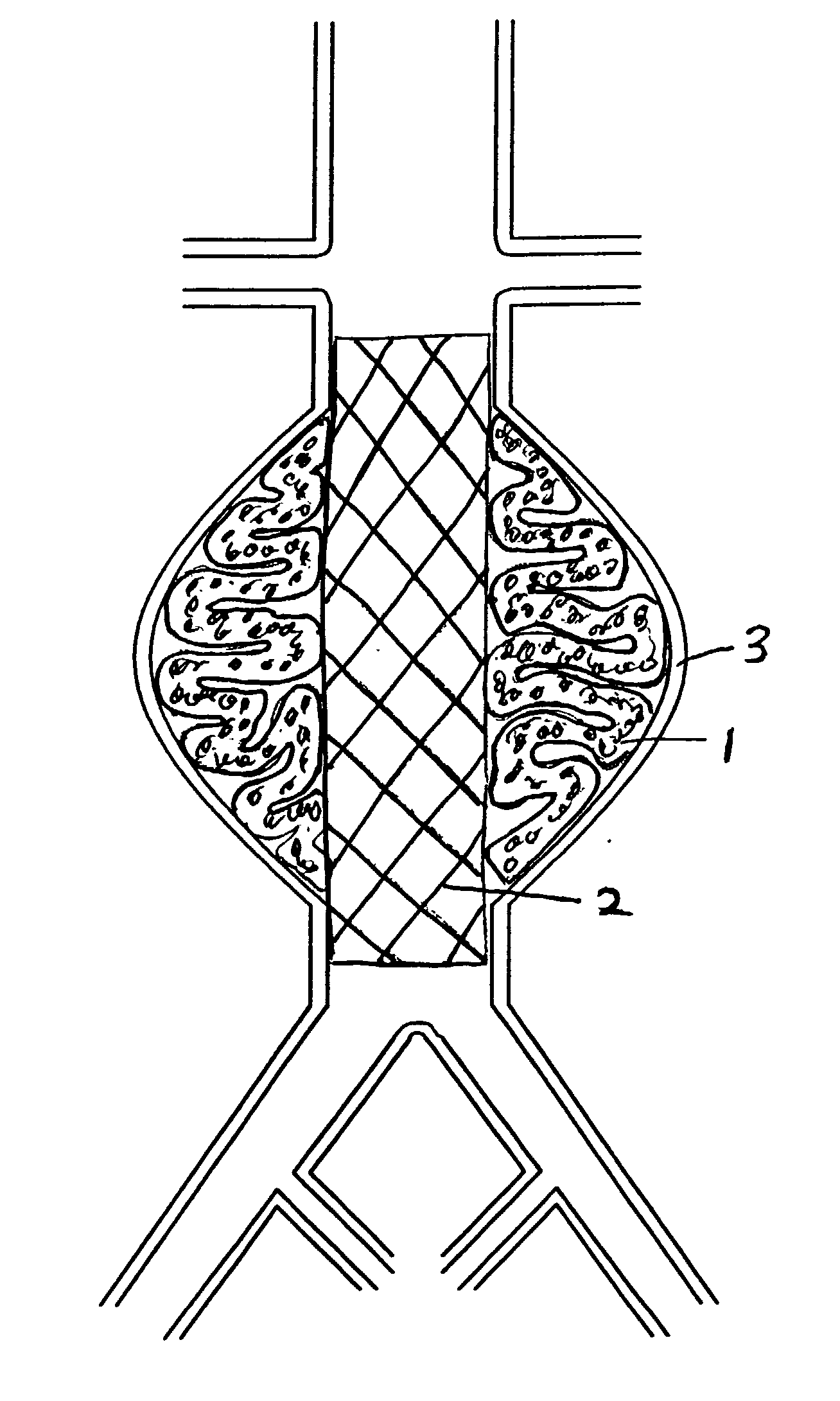 Devices and methods for treatment of vascular aneurysms