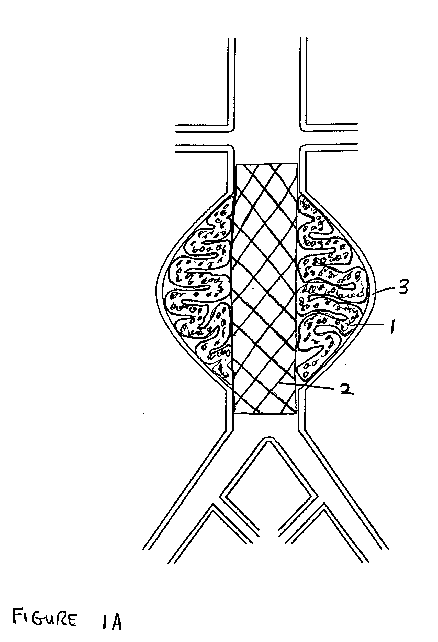 Devices and methods for treatment of vascular aneurysms