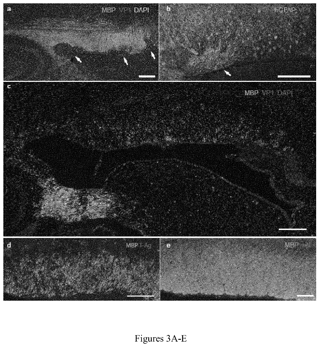 Human glial chimeric model for drug candidate assessment in human gliotrophic viral infections and progressive multifocal encephalopathy