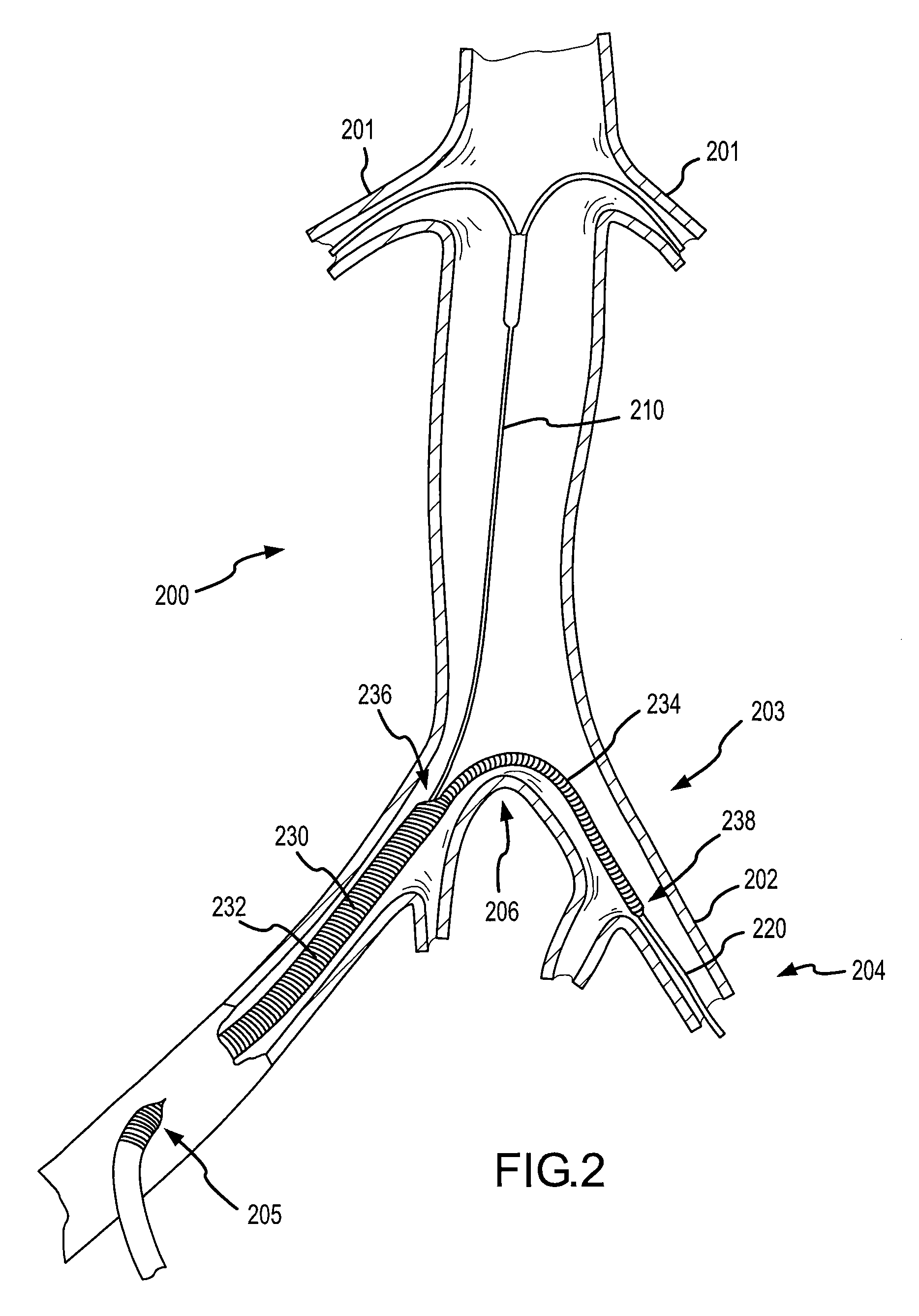 Vascular sheath with variable lumen construction