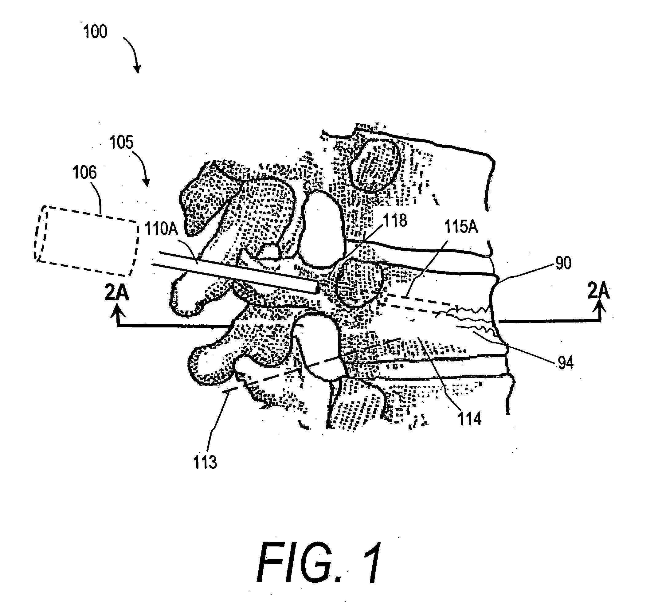 Bone treatment systems and methods