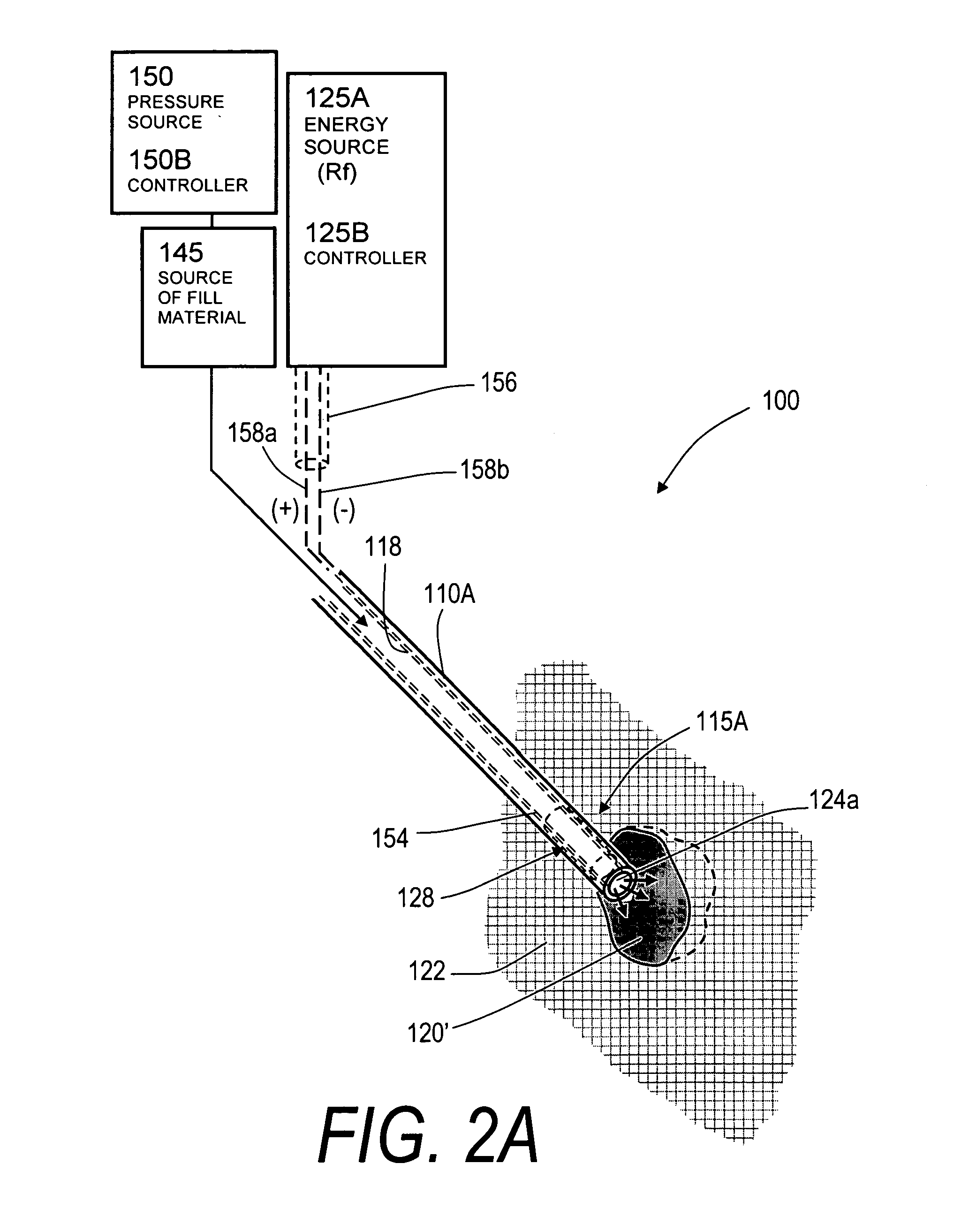 Bone treatment systems and methods