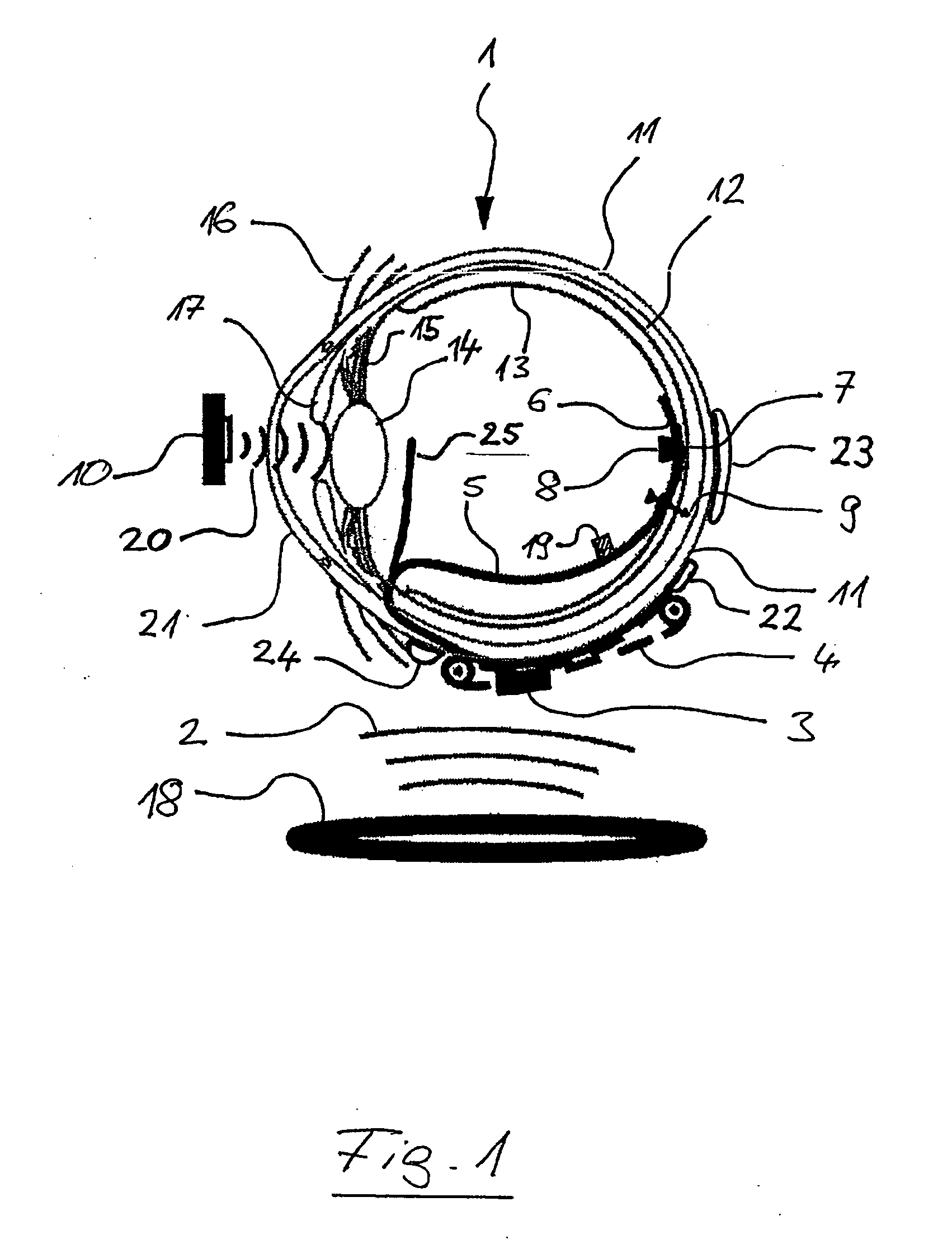 Extraocular epiretinal implant