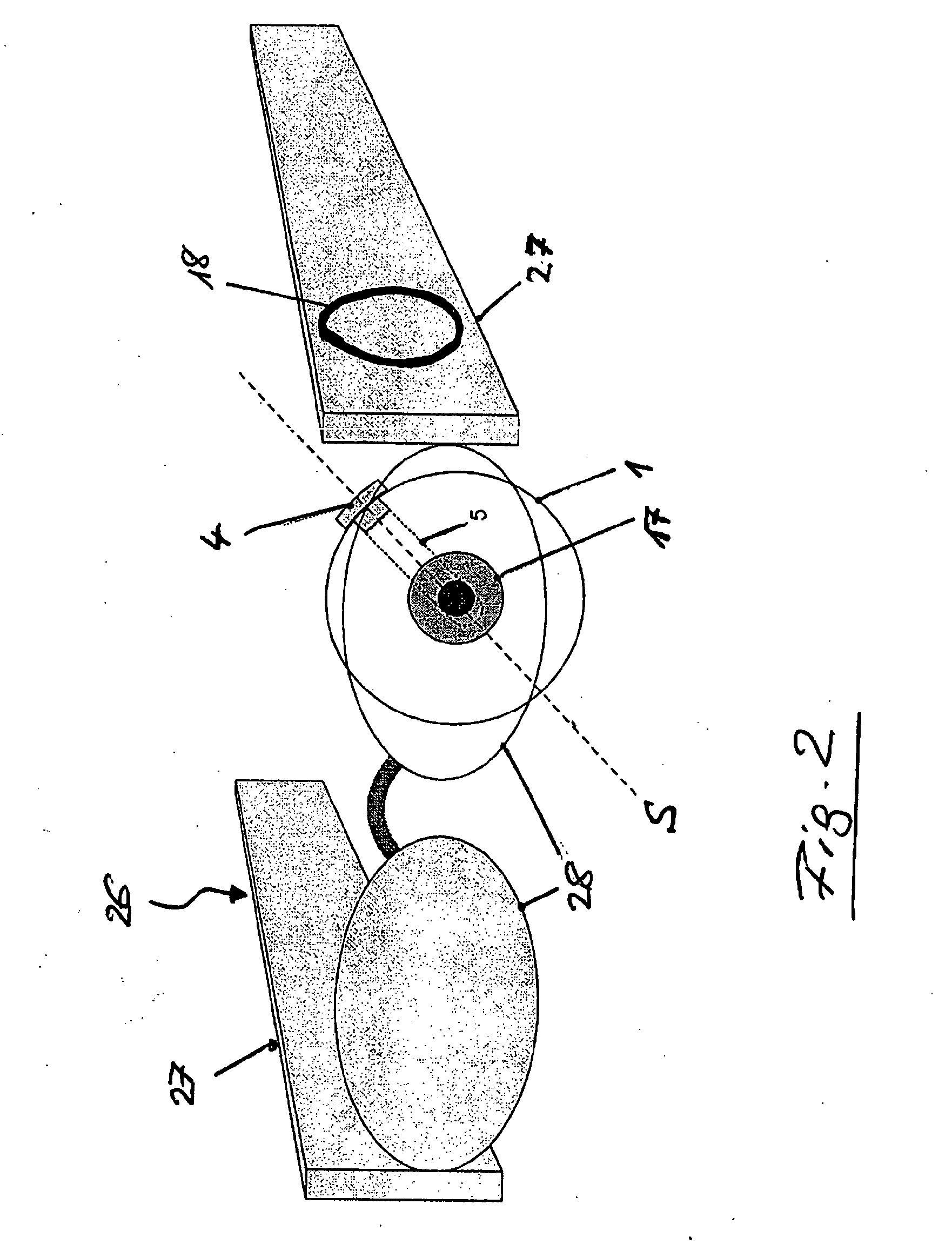 Extraocular epiretinal implant