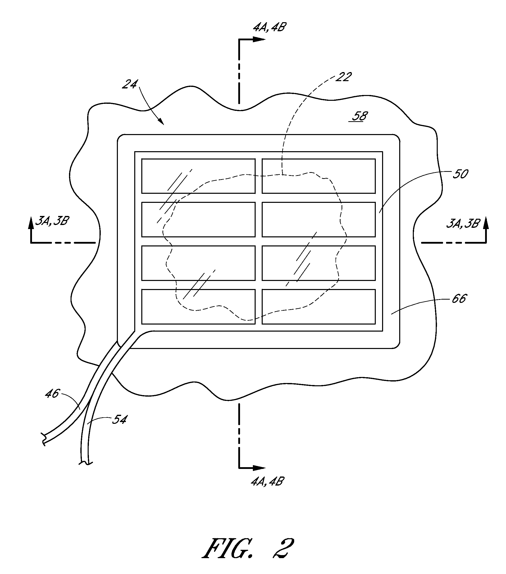 Negative Pressure Dressing and Method of Using Same