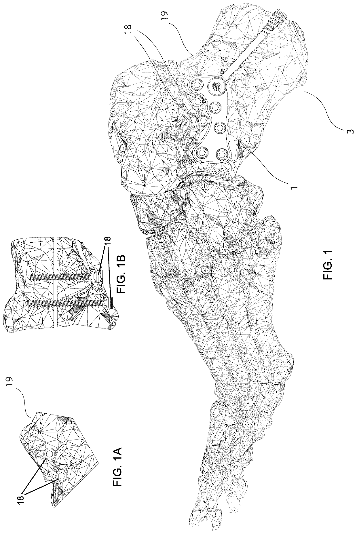 Calcaneal cross medullary plate