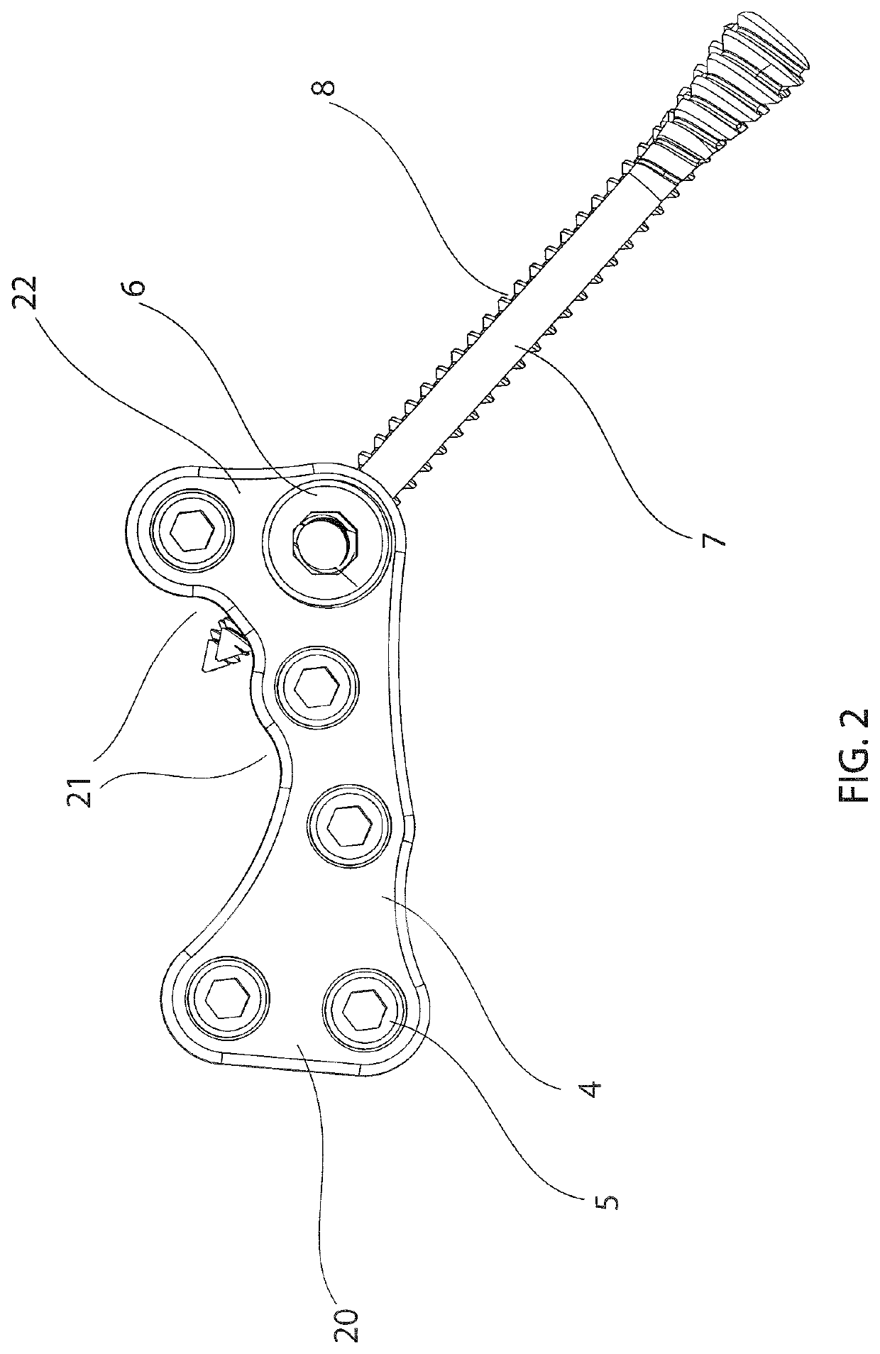 Calcaneal cross medullary plate