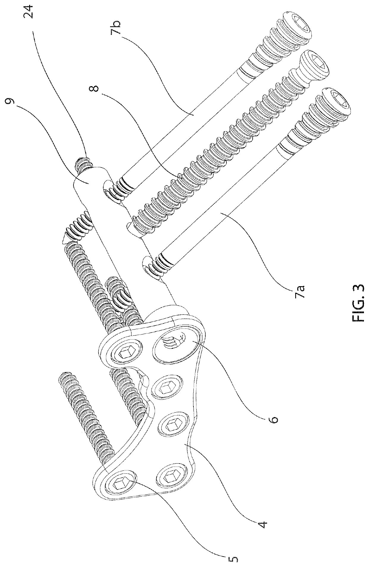 Calcaneal cross medullary plate