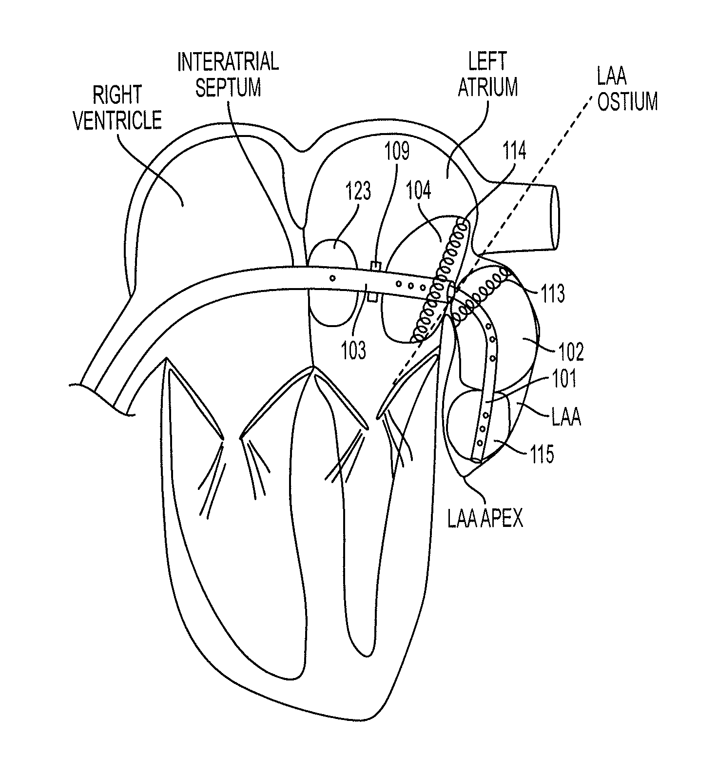 Methods and systems for accessing a pericardial space and preventing strokes arising from the left atrial appendage