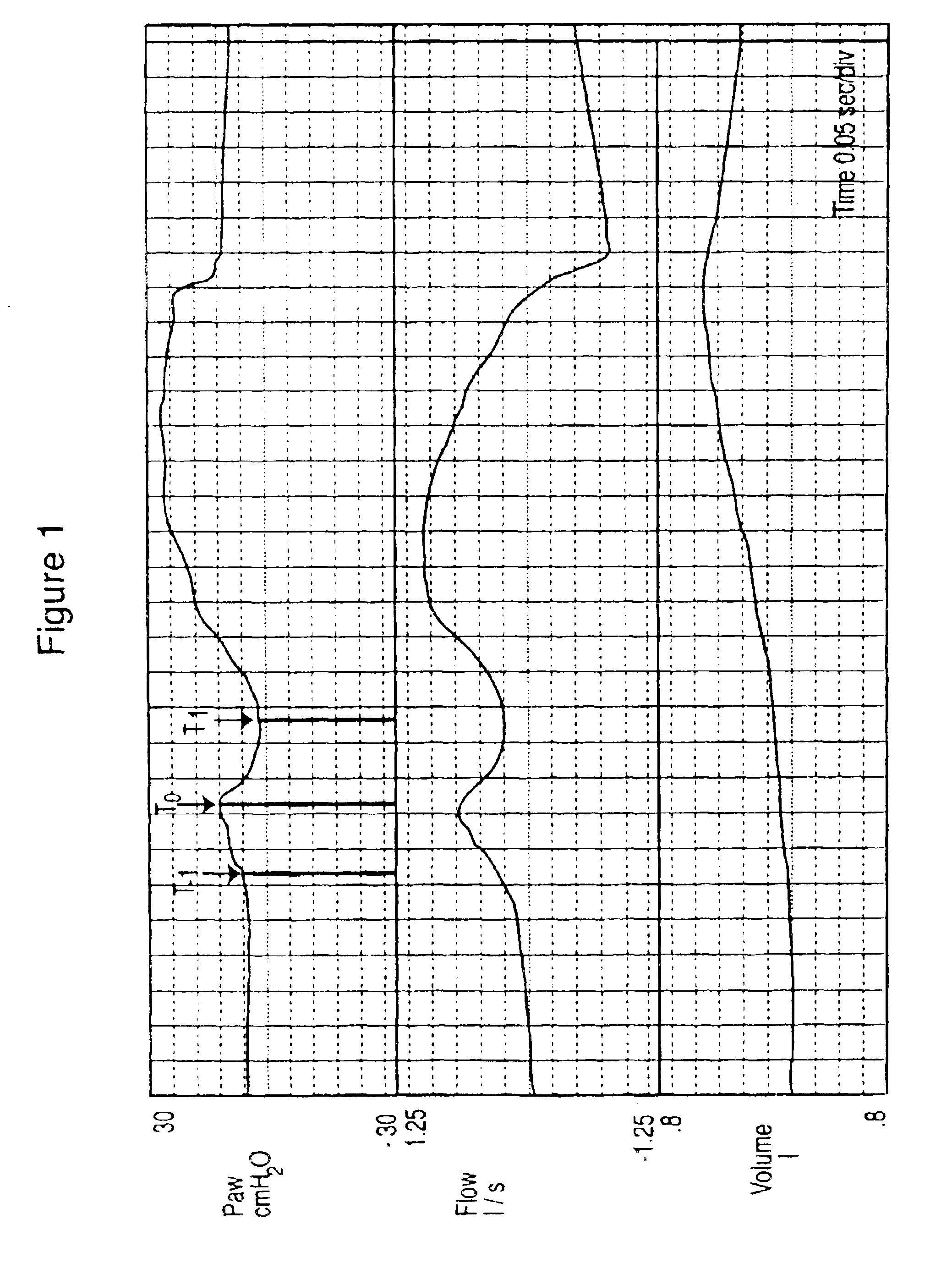 Method and apparatus for determining respiratory system resistance during assisted ventilation