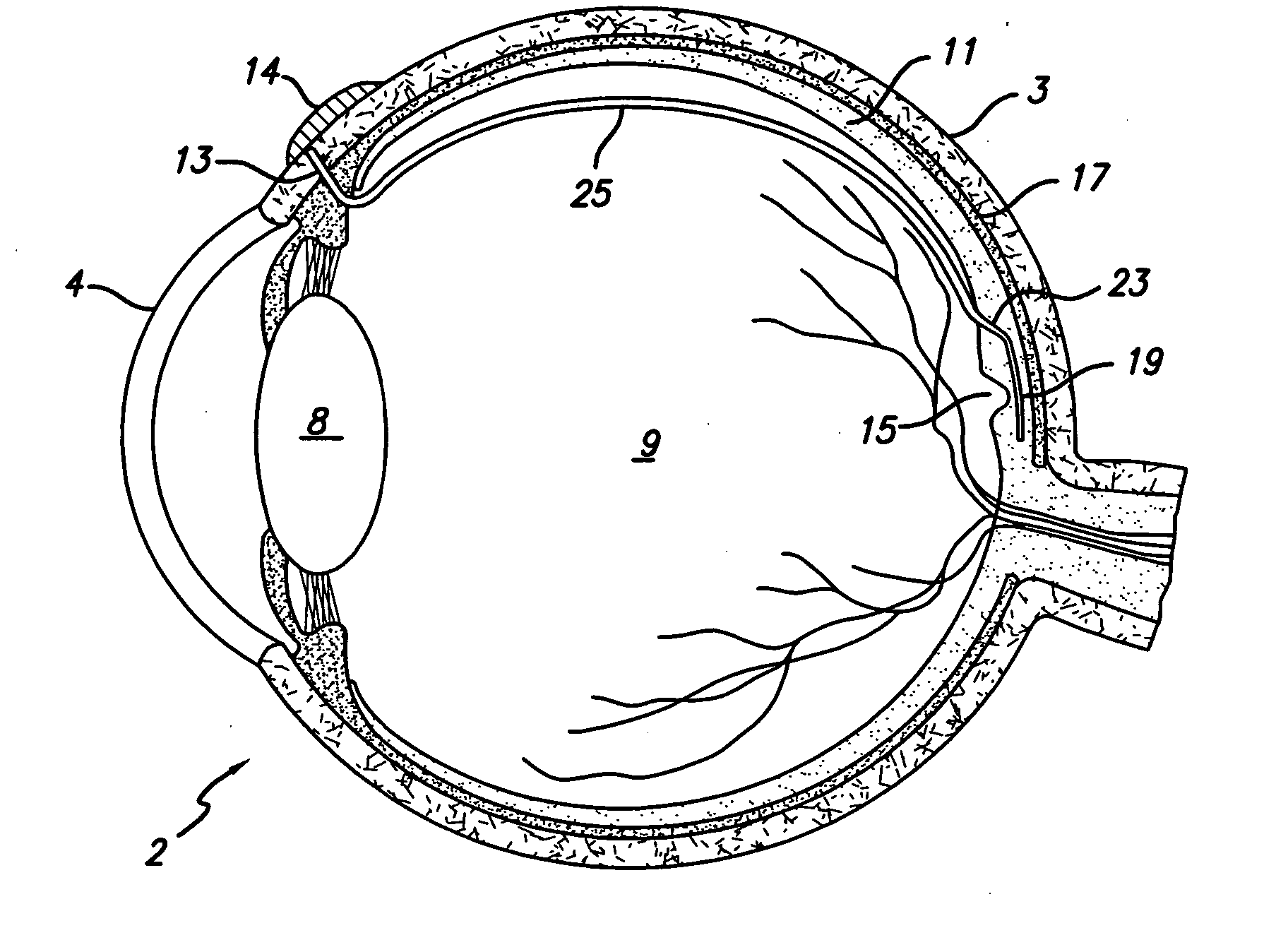 Trans-retinal flexible circuit electrode array