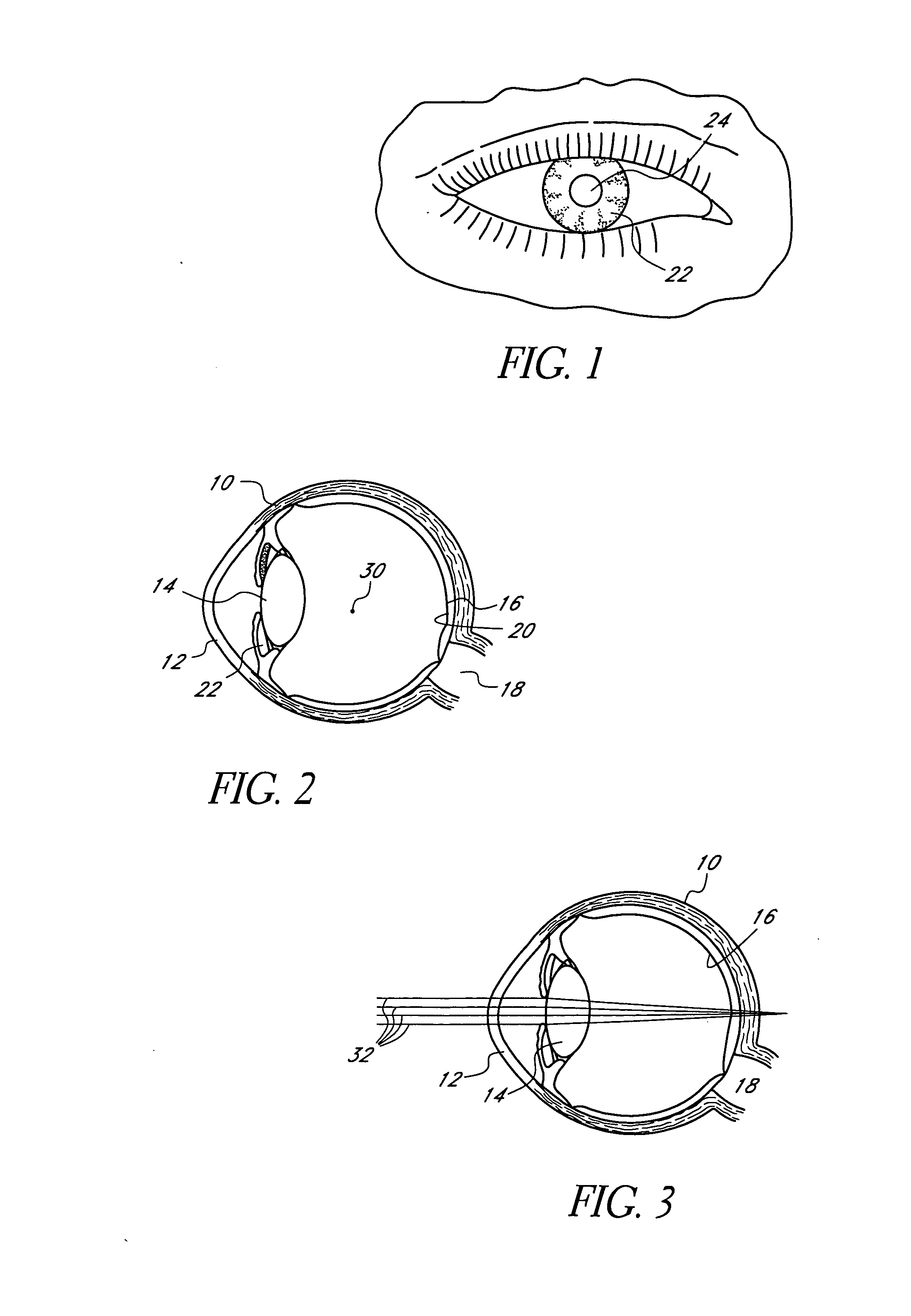 Method of making an ocular implant