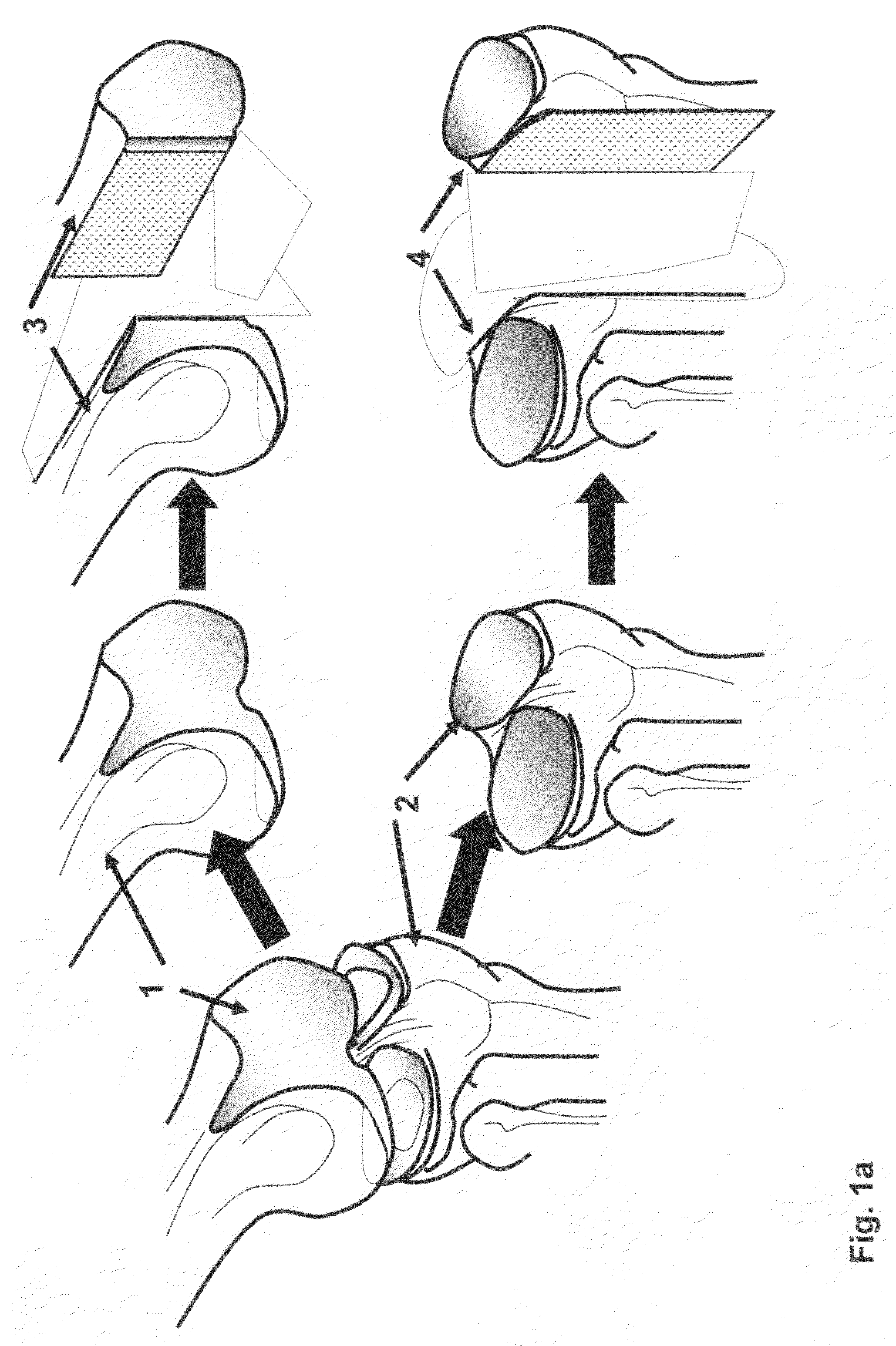 Devitalization and recellularization of cartilage