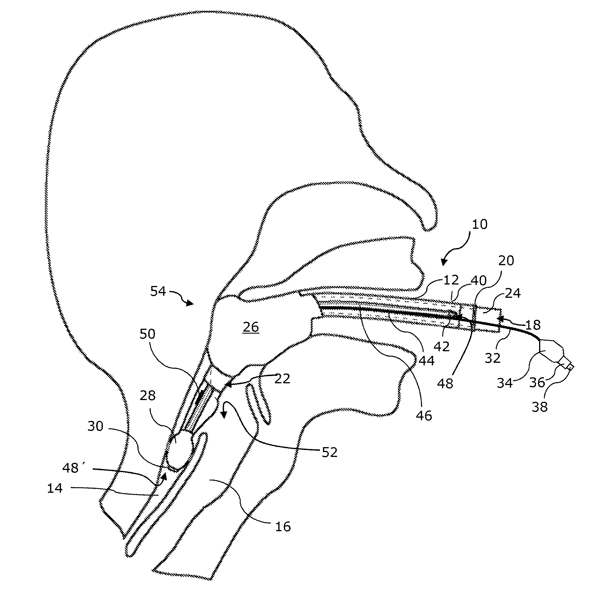 Larynx tube and method for the production thereof