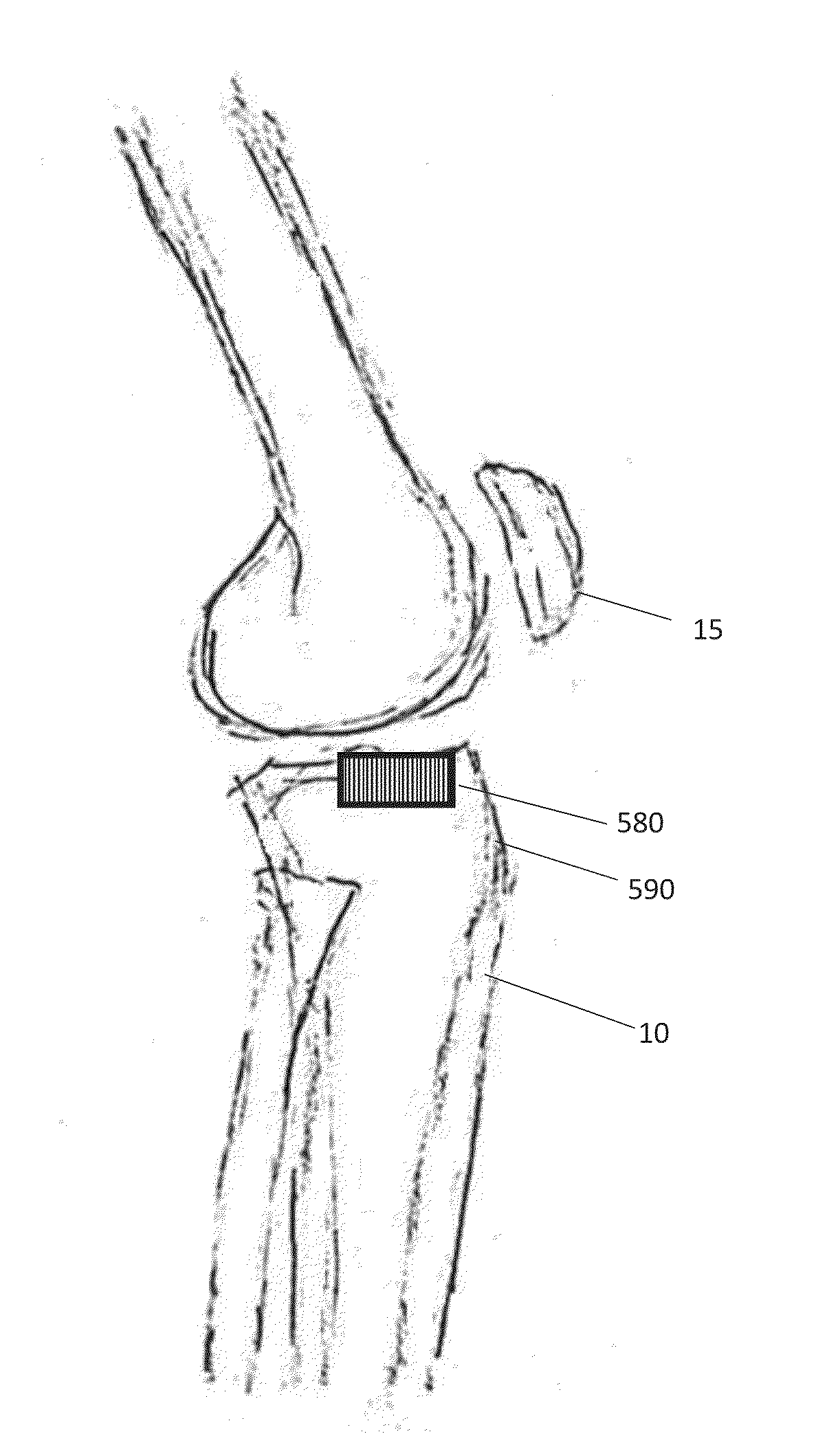 Total Knee Arthroplasty System and Method