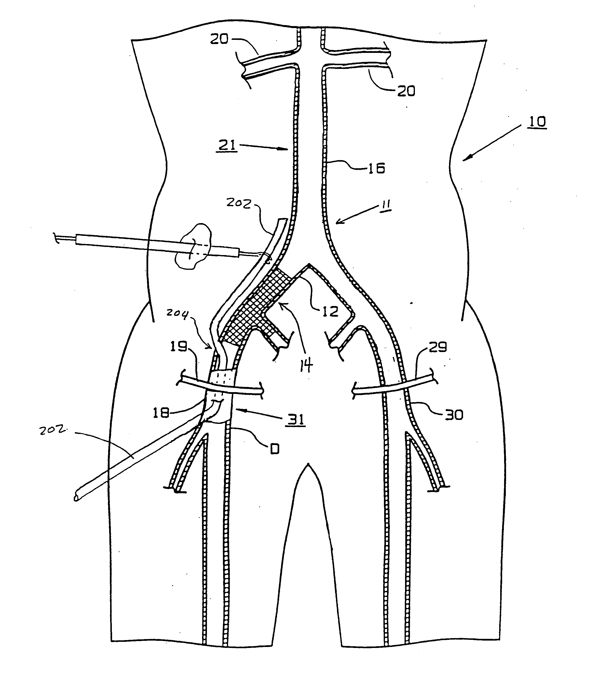 Vessel grafting method