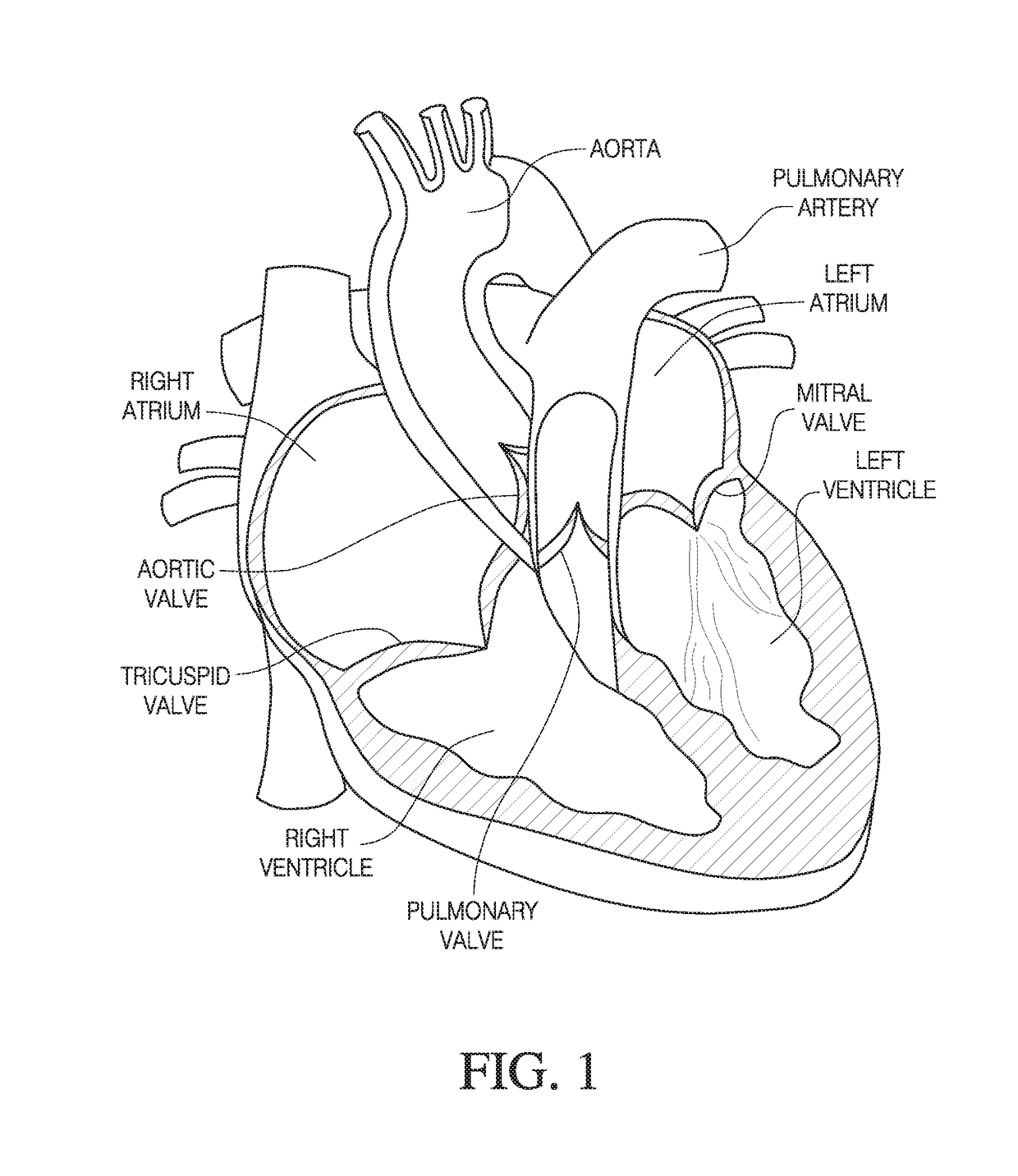 Prosthetic mitral valve holders