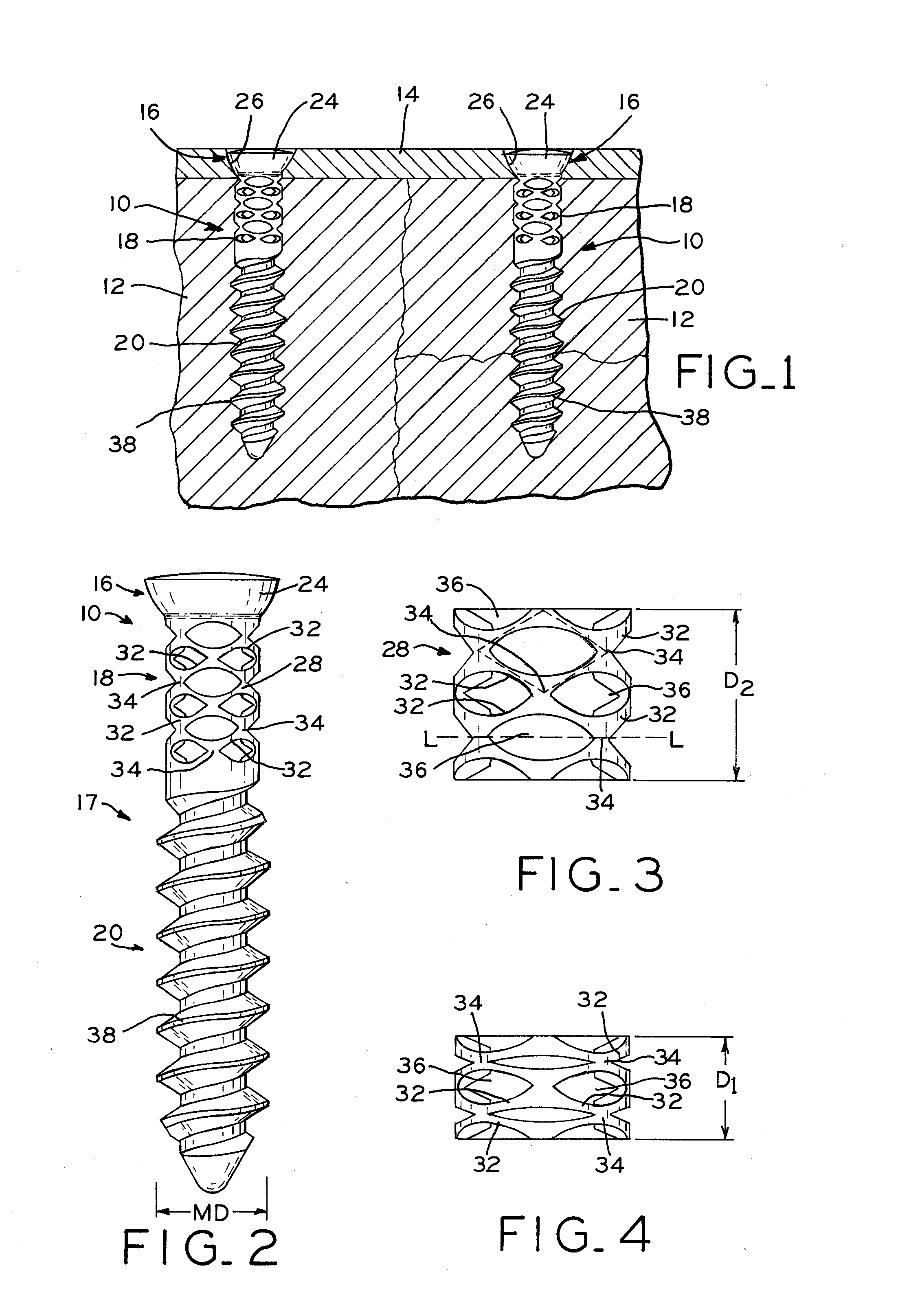 Bone screw for providing dynamic tension