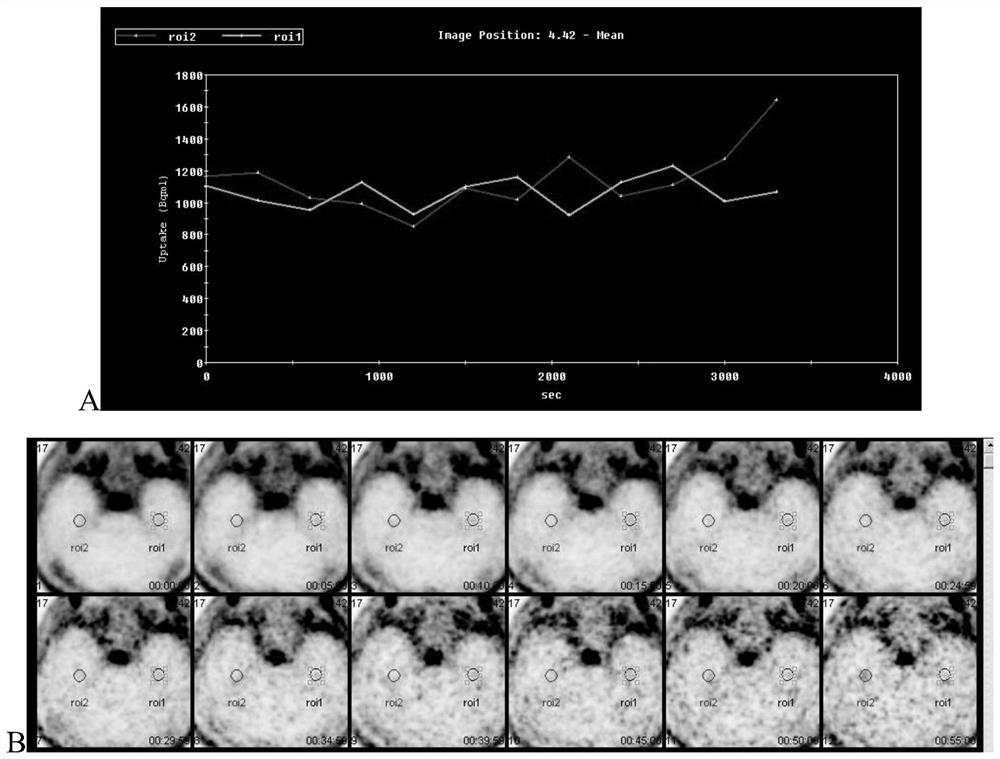 Method and system for identifying epileptic focus of temporal lobe epilepsy caused by hippocampal sclerosis and/or predicting pathological typing of epilepsy