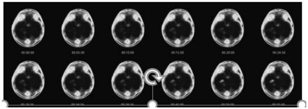 Method and system for identifying epileptic focus of temporal lobe epilepsy caused by hippocampal sclerosis and/or predicting pathological typing of epilepsy