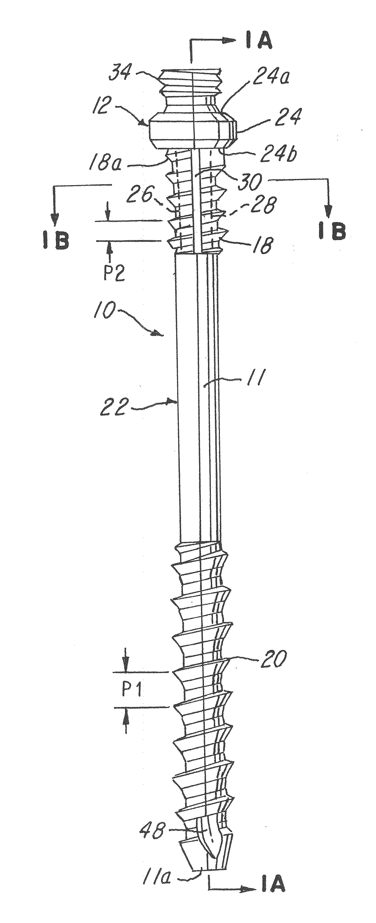 Spinal facet compression screw with variable pitch thread zones and buttress head