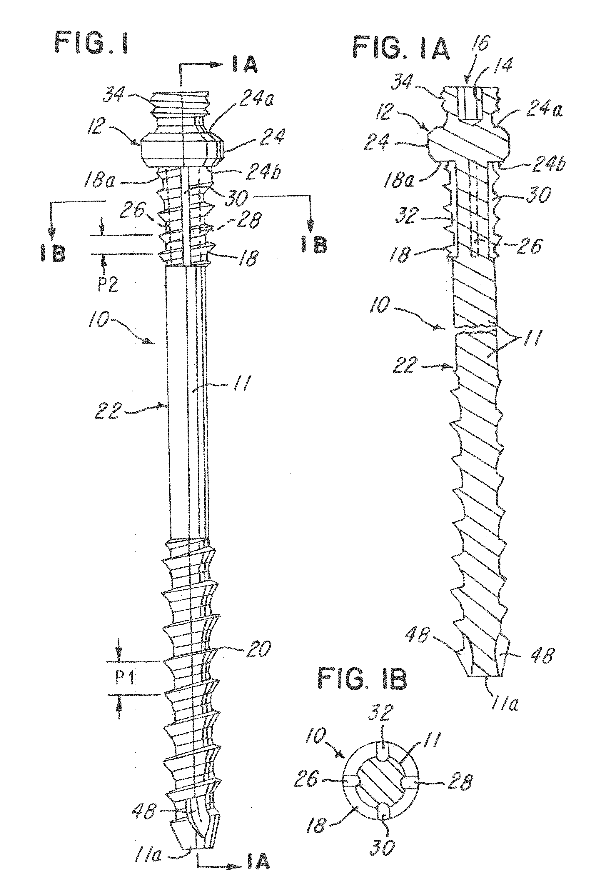 Spinal facet compression screw with variable pitch thread zones and buttress head