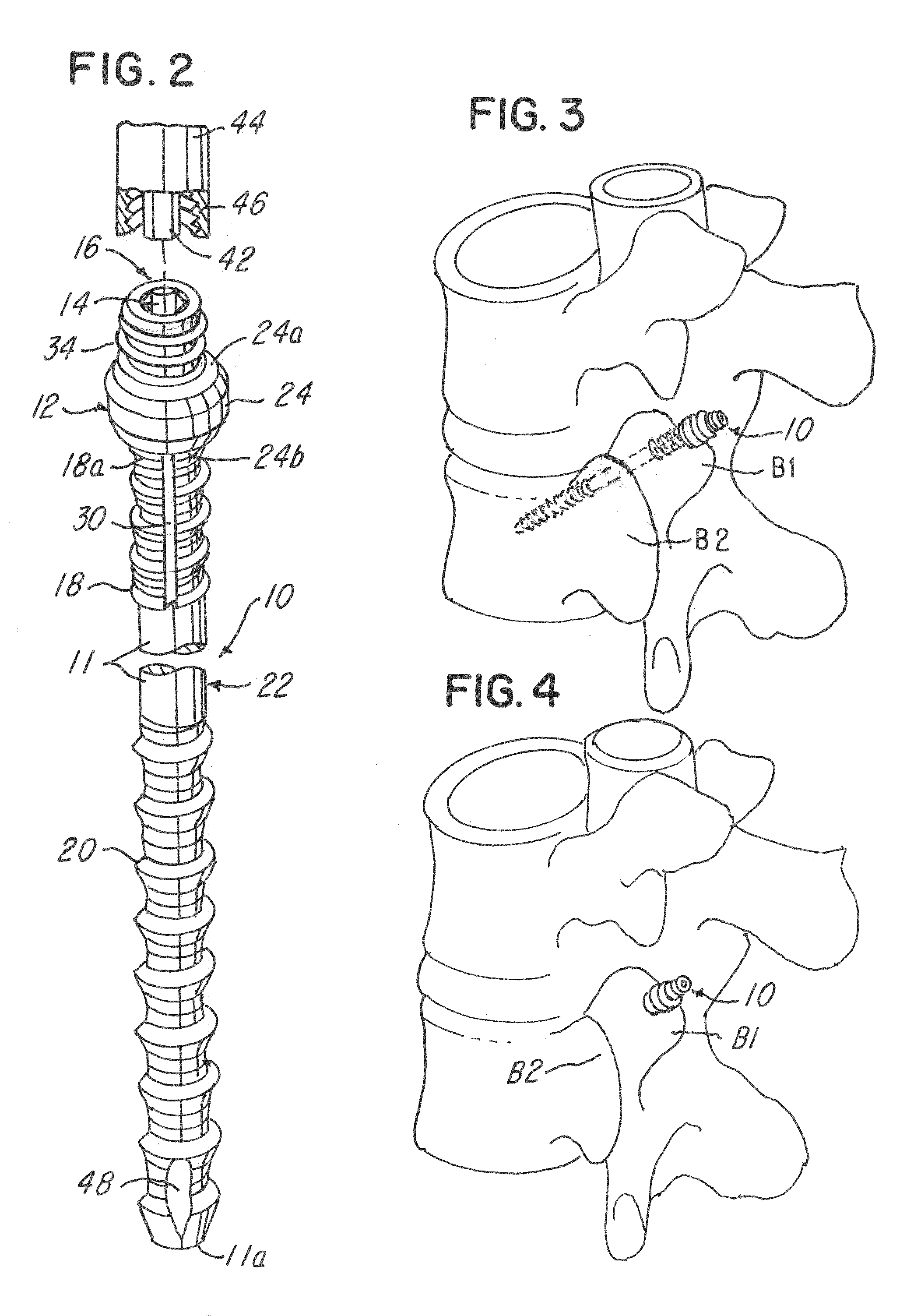 Spinal facet compression screw with variable pitch thread zones and buttress head