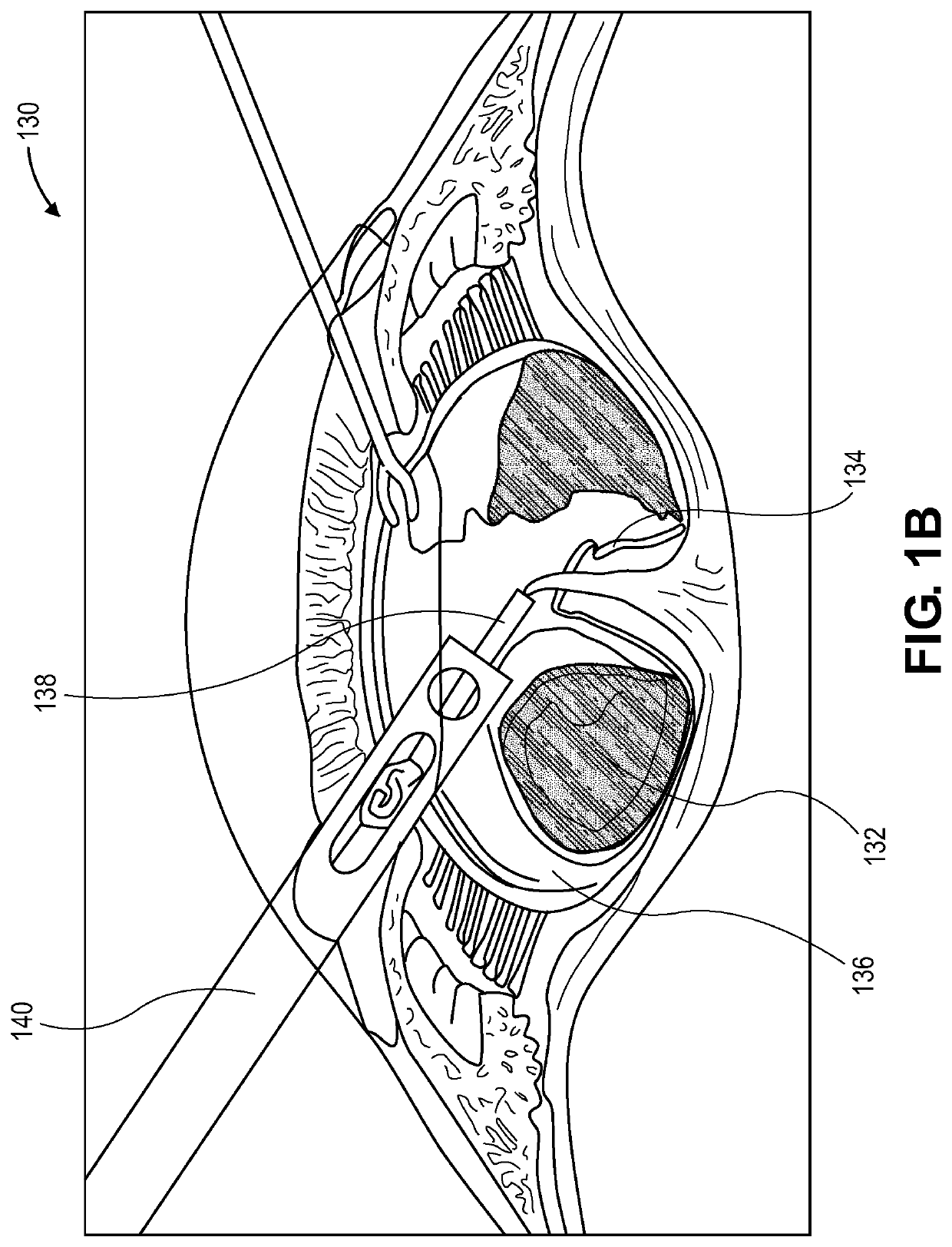 Method for eye lens removal using cavitating microbubbles