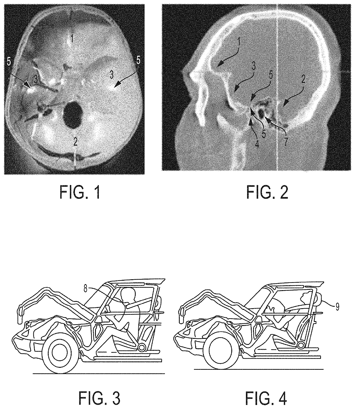 Low profile articulation jaw joint stabilizer device