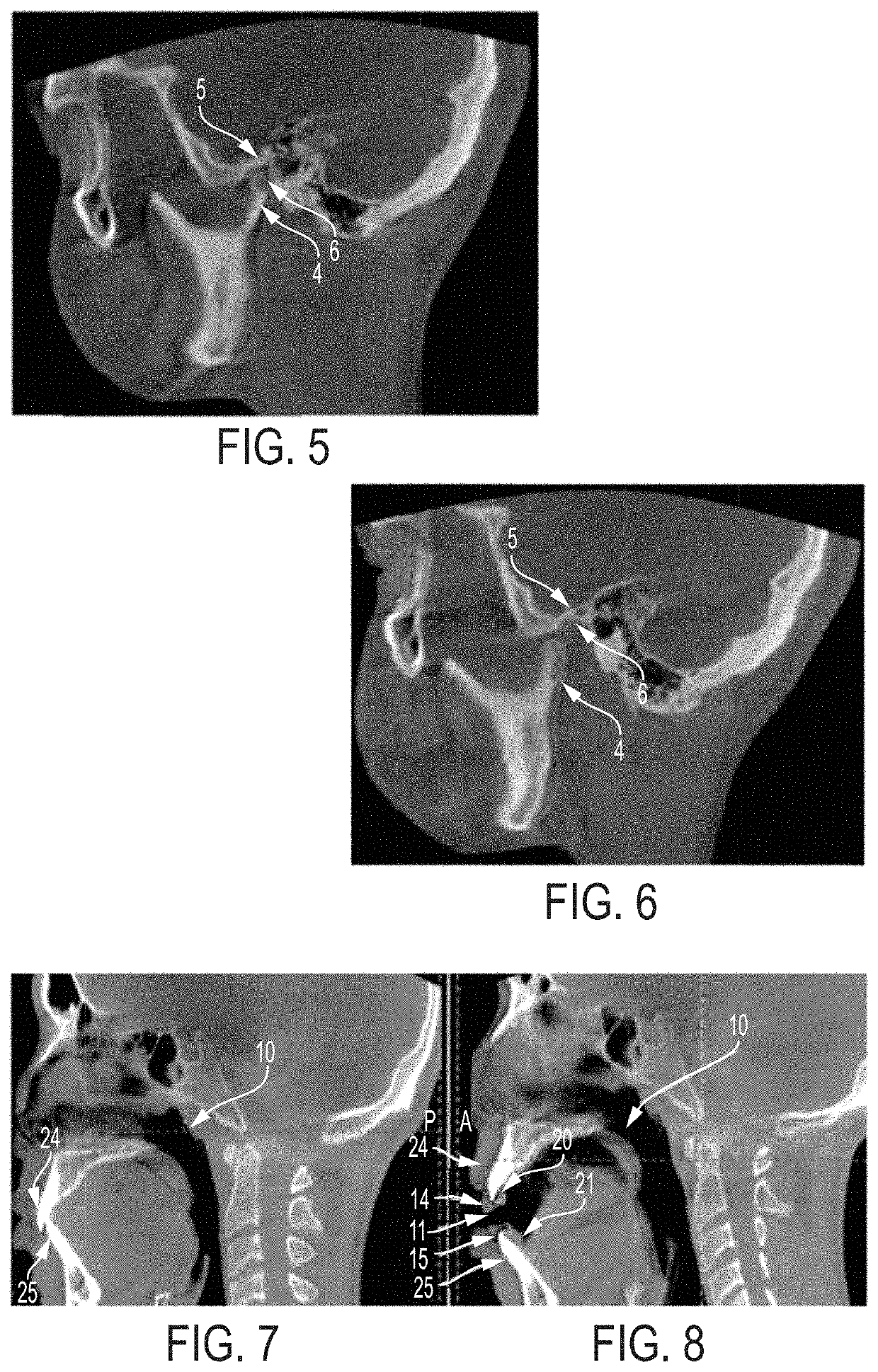 Low profile articulation jaw joint stabilizer device