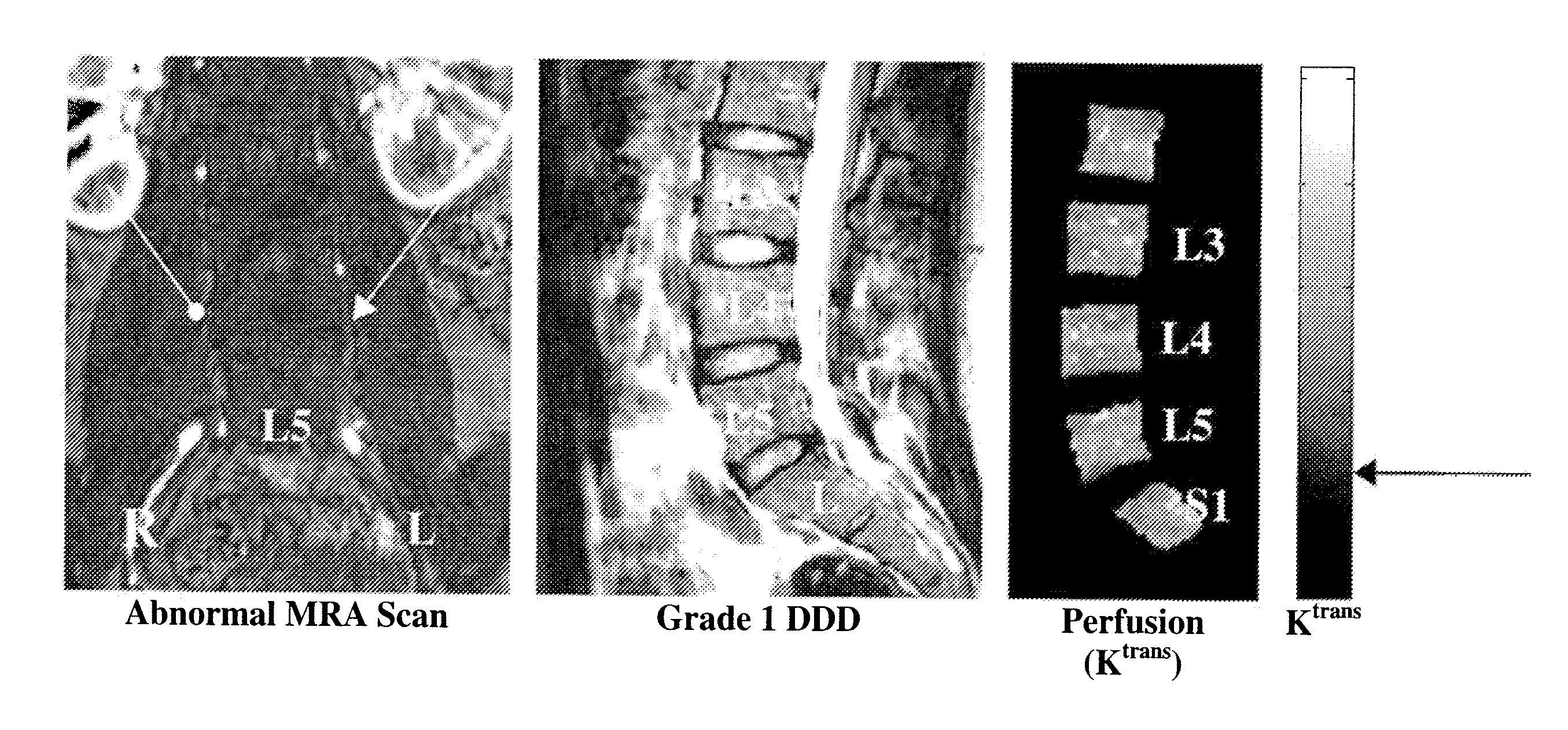 Therapeutic angiogenesis for treatment of the spine