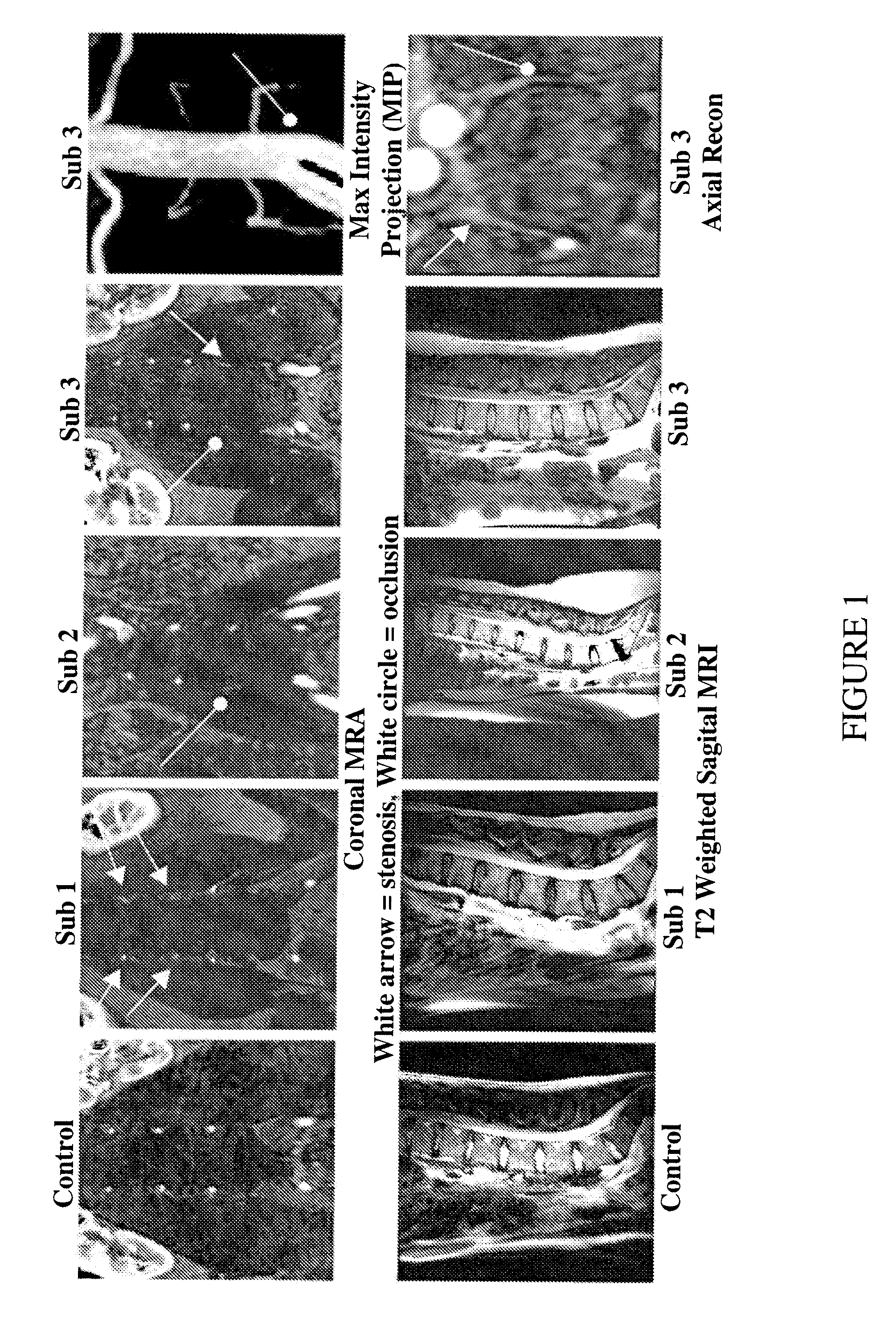 Therapeutic angiogenesis for treatment of the spine