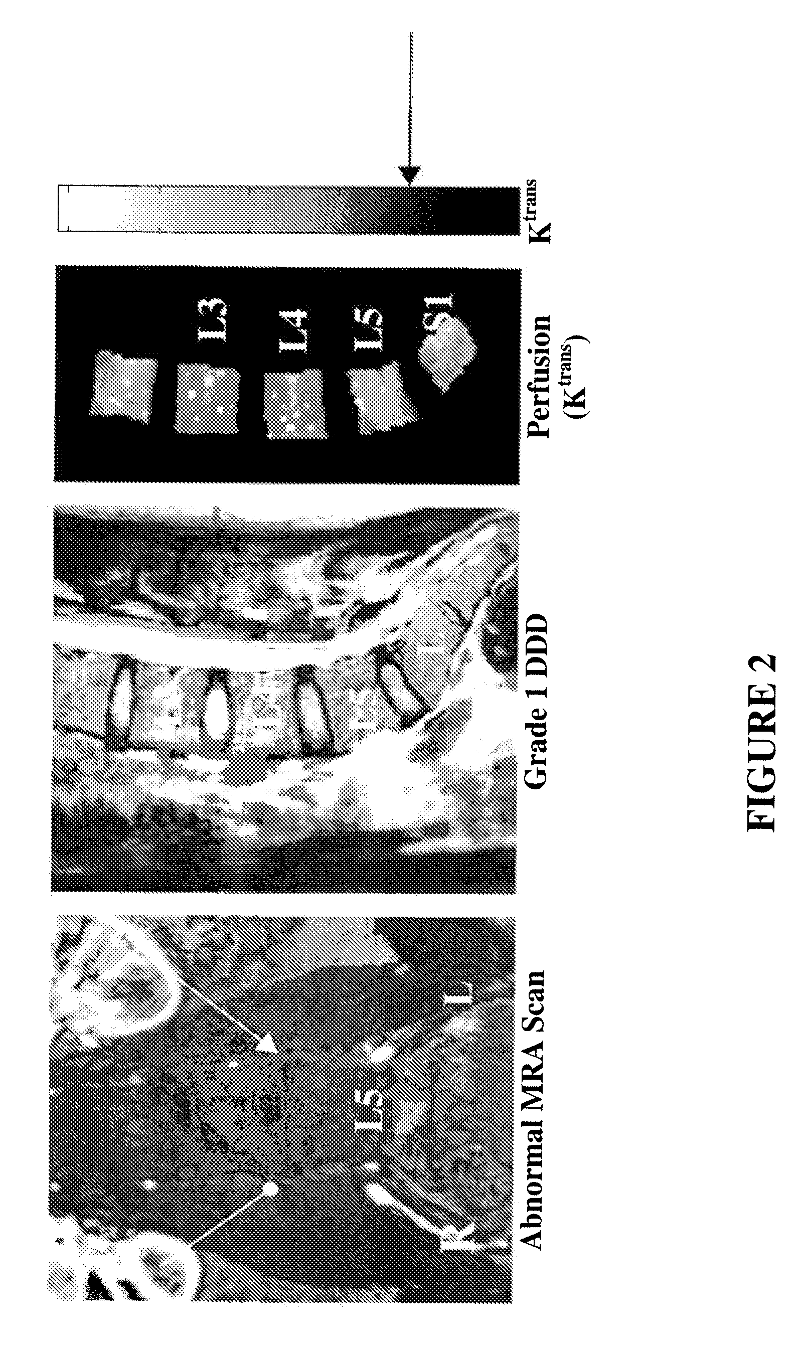 Therapeutic angiogenesis for treatment of the spine