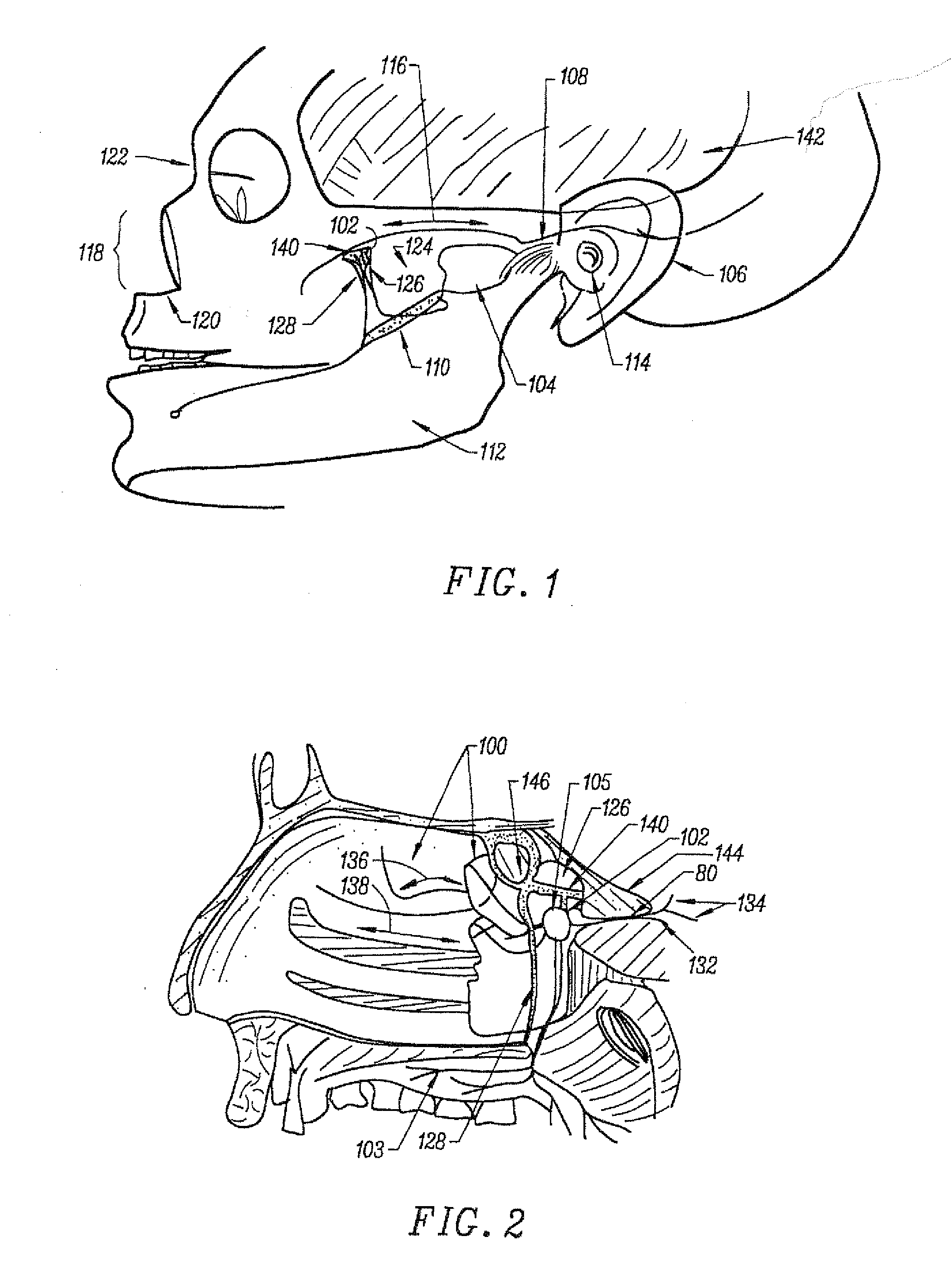 Stimulation method for the sphenopalatine ganglia, sphenopalatine nerve, or vidian nerve for treatment of medical conditions