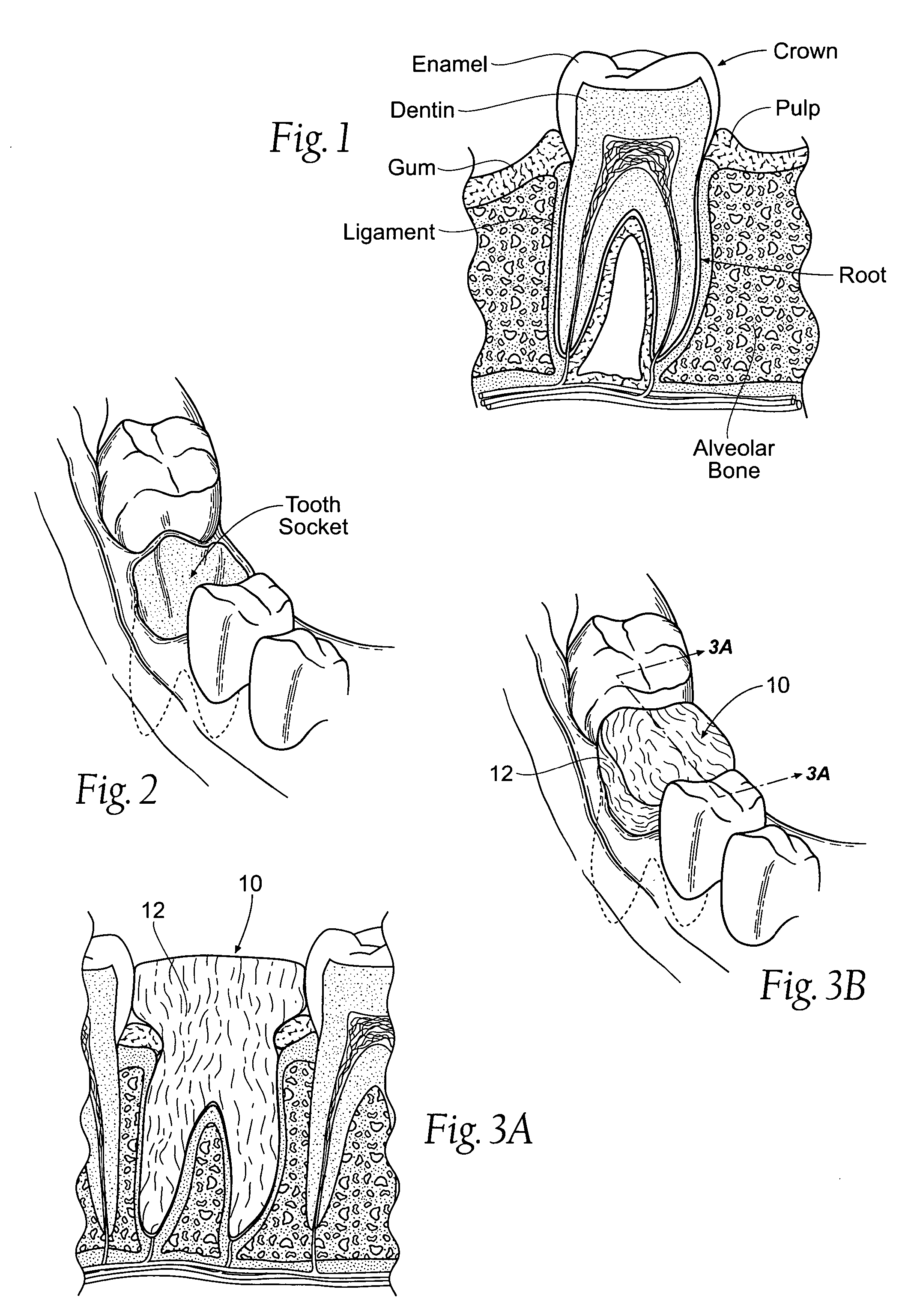 Compositions, assemblies, and methods applied during or after a dental procedure to ameliorate fluid loss and/or promote healing, using a hydrophilic polymer sponge structure such as chitosan