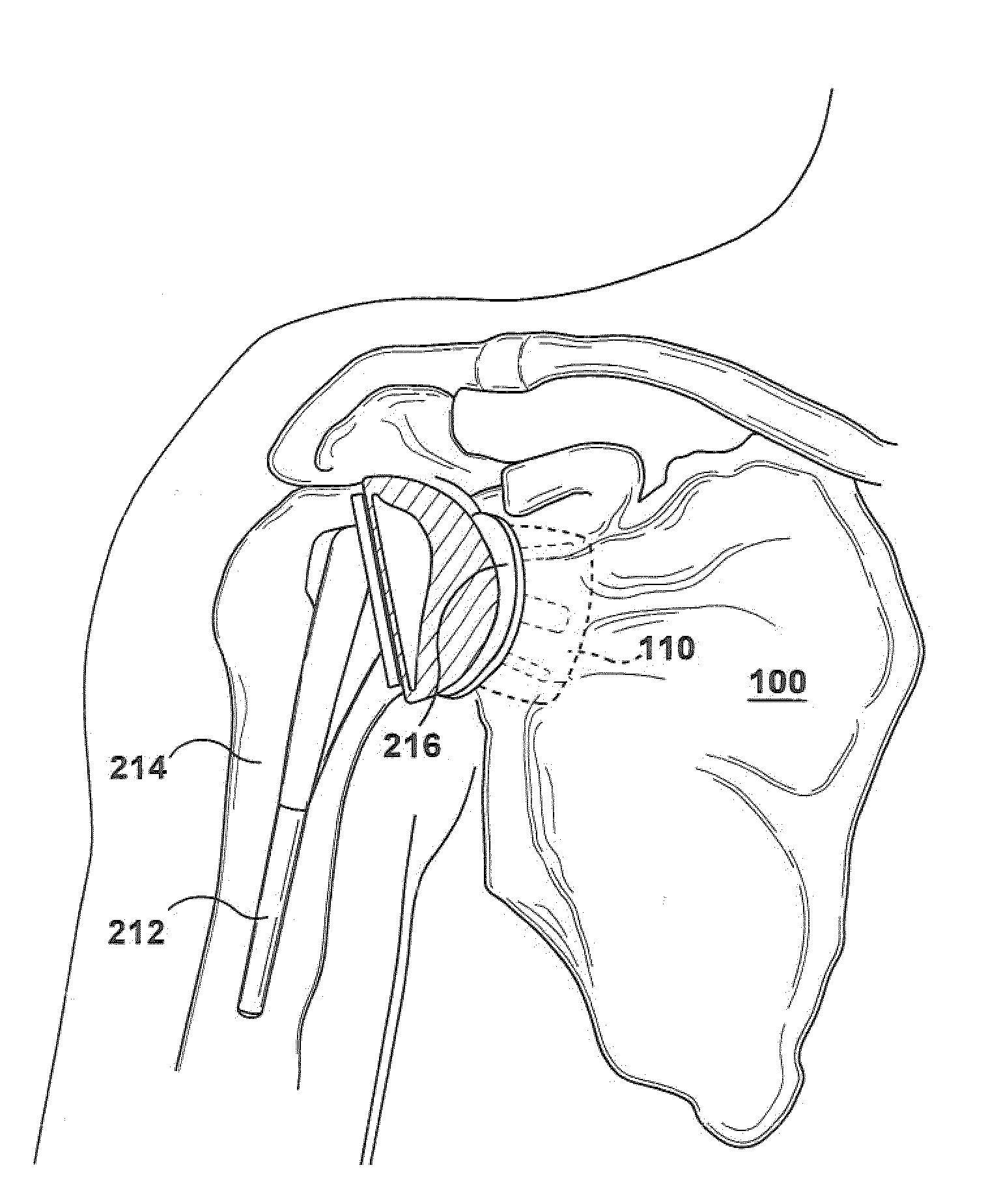 Method and apparatus for preparing for a surgical procedure